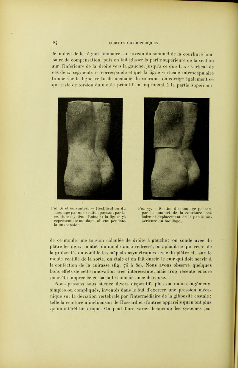 le milieu de la région lombaire, au niveau du sommet de la courbure lom- baire de compensation, puis on fait glisser la partie supérieure de la section siu' l'inférieur'^ de la droite vers la gauche, jusqu'à ce que l'axe vertical de ces deux segments se corresponde et que la ligne verticale interscapulaire tombe sur la ligne verticale médiane du sacrum ; on corrige également ce qui reste de torsion du moule primitif en imprimant à la partie supérieure Fin. 7G el piii\;uitcs. — Hcclification du moulage par une section passant i)ar la ceinture (système Rainai] : la figure 76 représente le moulage obtenu pendant la suspension. FiG. 77. — Section du moulage passan par le sommet de la courbure lom- baire et déplacement de la partie su- périeure du moulage. de ce moule une torsion calculée de droite à gauche; on soude avec du plâtre les deux moitiés du moule ainsi redressé, on aplanit ce qui reste de la gibbosité, on comble les méplats asymétriques avec du plâtre et, sur le moule rectifié de la sorte, on étale et on fait durcir le cuir qui doit servir à la confection de la cuirasse (fig. 76 à 80). Nous avons observé quelques bons effets de cette innovation très intéressante, mais trop récente encore pour être appréciée en parfaite connaissance de cause. Nous passons sous silence divers dispositifs plus ou moins ingénieux simples ou compliqués, inventés dans le but d'exercer une pression méca- nique sur la déviation vertébrale par l'intermédiaire de la gibbosité costale : telle la ceinture à inclinaison de Hossard et d'autres appareils qui n'ont plus qu'un intérêt historique. On peut faire varier beaucoup les systèmes par