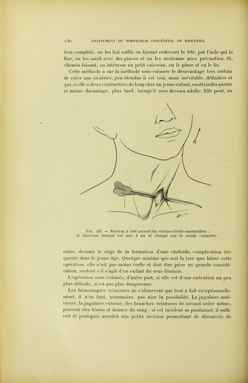 tion complète, on les fait saillir en faisant redresser la tête par l'aide qui la fixe, on les saisit avec des pinces et on les sectionne avec précaution. Si, chemin faisant, on intéresse un petit vaisseau, on le pince et on le lie. Cette méthode a sur la méthode sous-cutanée le désavantage très certain de créer une cicatrice, peu étendue il est vrai, mais inévitable, définitive et qui, si elle a deux centimètres de longchez un jeune enfant, enatteindra quatre et même davantage, plus tard, lorsqu'il sera devenu adulte. Elle peut, en FiG. i33. — Section à ciel ouvert du sterno-cléido-niasloïdien : le faisceau slernal est mis à nu et chargé sur la sonde cannelée. outre, devenir le siège de la formation d'une chéloïde, complication fré- quente dans le jeune âge. Quelque minime que soit la tare que laisse cette opération, elle n'est pas moins réelle et doit être prise en grande considé- ration, surtout s'il s'agit d'un enfant du sexe féminin. L'opération sous-cutanée, d'autre part, si elle est d'une exécution un peu plus délicate, n'est pas plus dangereuse. Les hémorragies veineuses ne s'observent que tout à fait exceptionnelle- ment, il n'en faut, néanmoins, pas nier la possibilité. La jugulaire anté- rieure, la jugulaire externe, des branches veineuses de second ordre même, peuvent être lésées et donner du sang ; si cet incident se produisait, il suffi- rait de pratiquer aussitôt une petite incision permettant de découvrir, de