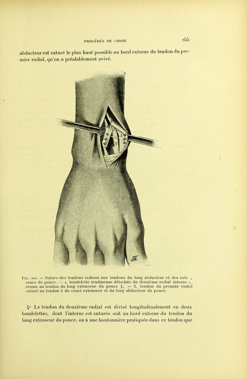 abducteur est suturé le plus haut possible au bord externe du tendon du pre- mier radial, qu'où a préalablement avivé. FiG. 200. — Suture des tendons radiaux aux tendons du long abducteur et des exte _ seurs du pouce. — i, bandelette tendineuse détachée du deuxième radial interne 2, réunie au tendon du long extenseur du pouce 4; — 3, tendon du premier radial suturé au tendon 5 du court extenseur et du long abducteur du pouce. 40 Le tendon du deuxième radial est divisé longitudinalement en deux bandelettes, dont l'interne est suturée soit au bord externe du tendon du long extenseur du pouce, ou à une boutonnière pratiquée dans ce tendon que