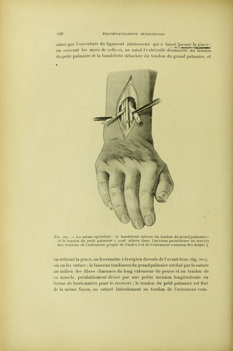 ainsi que l'ouverture du ligament interosseux qui a laissé [passer la pince ; en ouvrant les mors de celle-ci, on saisit lextréinité désinsérée du tendon du petit palmaire et la bandelette détachée du tendon du grand palmaire, et Fia. 202. — La même opéralion : la bandeleUe interne du tendon du grand'palmaire i et le tendon du petit palmaire 2 sont attirés dans l'incision postérieuic au travers des tendons de l'extenseur j)ropre de l'index 3 et de l'extenseur commun des doigts /J. en retirant la pince, on les ramène à la région dorsale de l'avant-bras (lig. 20 où on les suture ; le faisceau tendineux du grand palmaire est fixé par la suture au milieu des fibres charnues du long extenseur du pouce et au tendon de ce muscle, préalablement divisé par une petite incision longitudinale en l'orme de boutonnière pour le recevoir ; le tendon du petit palmaire est fixé de la môme fa(^'on, ou suturé latéralement au tendon de l'exlenseur coin-