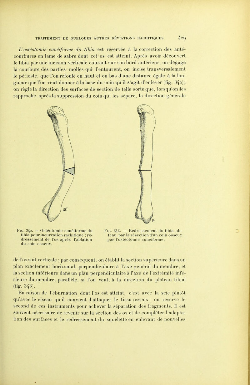 L'ostéotomie cunéiforme du tibia est réservée à la correction des anté- courbures en lame de sabre dont cet os est atteint. Après avoir découvert le tibia par une incision verticale courant sur son bord antérieur, on dégage la courbure des parties molles qui l'entourent, on incise transversalement le périoste, que l'on refoule en haut et en bas d'une distance égale à la lon- gueur que l'on veut donner à la base du coin qu'il s'agit d'enlever (fig. 342) ; on règle la direction des surfaces de section de telle sorte que, lorsqu'on les rapproche, après la suppression du coin qui les sépare, la direction générale Fig. 3/J2. — Ostéotomie cunéiforme du Fig. 343. — Redressement du lil^ia ob- tibia pour incurvation rachitique ; re- tenu par la résection d'un coin osseux dressement de l'os après l'ablation par l'ostéotomie cunéiforme, du coin osseux. de l'os soit verticale ; par conséquent, on établit la section supérieure dans un plan exactement horizontal, perpendiculaire à l'axe général du membre, et la section inférieure dans un plan perpendiculaire à l'axe de l'extrémité infé- rieure du membre, parallèle, si l'on veut, à la direction du plateau tibial (fig. 343). En raison de l'éburnation dont l'os est atteint, c'est avec la scie plutôt qu'avec le ciseau qu'il convient d'attaquer le tissu osseux; on réserve le second de ces instruments pour achever la séparation des fragments. Il est souvent nécessaire de revenir sur la section des os et de compléter l'adapta- tion des surfaces et le redressement du squelette en enlevant de nouvelles