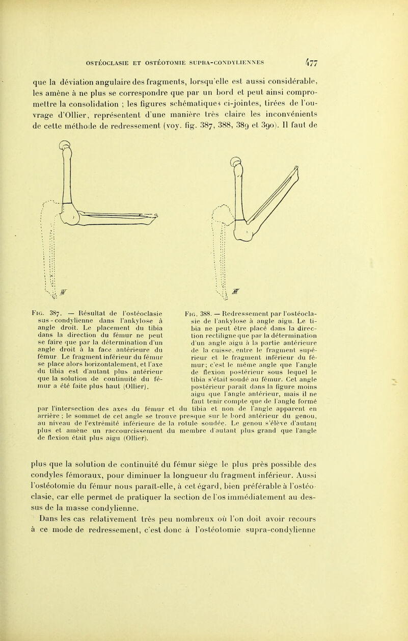 que la déviation angulaire des fragments, lorsqu'elle est aussi considérable, les amène à ne plus se correspondre que par un bord et peut ainsi compro- mettre la consolidation ; les figures schématiques ci-jointes, tirées de l'ou- vrage d'Ollier, représentent d'une manière très claire les inconvénients de cette méthode de redressement (voy. fig. 887, 388, 889 et 890). Il faut de W Fig. 387. — Résultat de l'ostéoclasie sus - condylienne dans l'ankylose à angle droit. Le placement du tibia dans la direction du fémur ne peut se faire que par la détermination d'un angle droit à la face antérieure du fémur Le fragment inférieur du fémur se place alors horizontalement, et l'axe du tibia est d'autant plus antérieur que la solution de continuité du fé- mur a été faite plus haut (OUier). par l'intersection des a.xes du fémur et arrière ; le sommet de cet angle se trouve au niveau de l'extrémité inférieure de la plus et amène un raccourcissement du de fle.xion était plus aigu (Ollier). Fig. 388. — Redressement par l'ostéocla- sie de l'ankylose à angle aigu. Le ti- bia ne peut être placé dans la direc- tion rectiligne que par la détermination d'un angle aigu à la partie antérieure de la cuisse, entre le fragment supé- rieur et le fragment inférieur du fé- mur; c'est le même angle que l'angle de flexion postérieur sous lequel le tibia s'était soudé au fémur. Cet angle postérieur paraît dans la figure moins aigu que l'angle antérieur, mais il ne faut tenir compte que de l'angle formé du tibia et non de l'angle apparent en presque sur le bord antérieur du genou, rotule soudée. Le genou s'élève d'autant membre d'autant plus grand que l'angle plus que la solution de continuité du fémur siège le plus près possible des condyles fémoraux, pour diminuer la longueur du fragment inférieur. Aussi l'ostéotomie du fémur nous paraît-elle, à cet égard, bien préférable à l'ostéo- clasie, car elle permet de pratiquer la section de l'os immédiatement au des- sus de la masse condylienne. Dans les cas relativement très peu nombreux où l'on doit avoir recours à ce mode de redressement, c'est donc à l'ostéotomie supra-condylienne