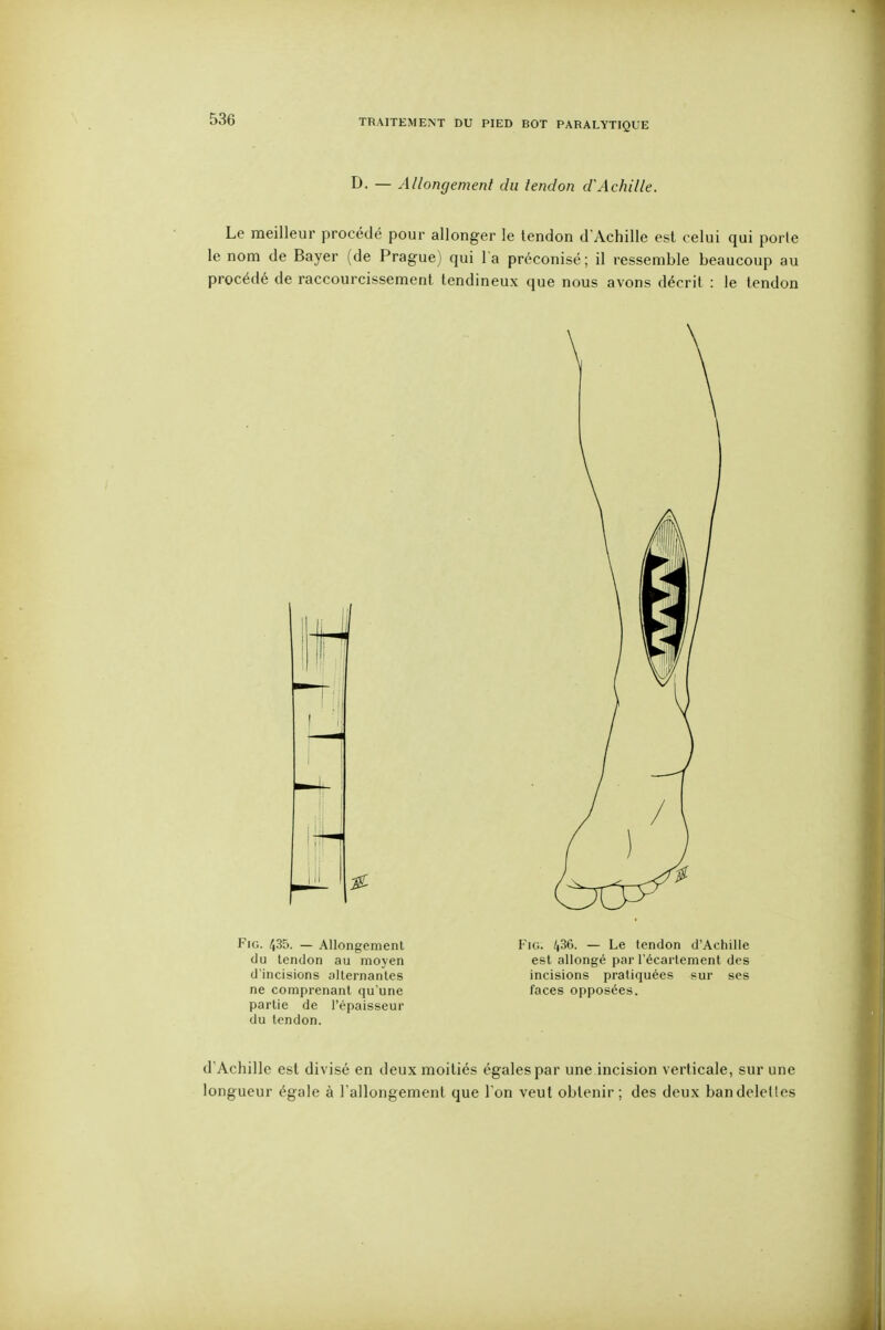 D- — Allongement du tendon d'Achille. Le meilleur procédé pour allonger le tendon d'Achille est celui qui porte le nom de Bayer (de Prague) qui l'a préconisé; il ressemble beaucoup au procédé de raccourcissement tendineux que nous avons décrit : le tendon d'Achille est divisé en deux moitiés égales par une incision verticale, sur une longueur égale à l'allongement que I on veut obtenir ; des deux bandelelles