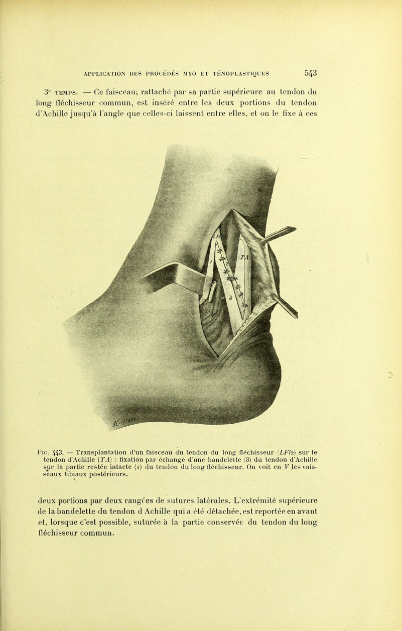 3*^ TEMPS. — Ce faisceau; rattaché par sa partie supérieure au tendon du long fléchisseur commun, est inséré entre les deux portions du tendon d'A.chille jusqu'à l'angle que celles-ci laissent entre elles, et on le fixe à ces FiG. 443. — Transplantation d'un faisceau du tendon du long fléchisseur [LFh) sur le tendon d'Achille {TA) : fixation par échange d'une bandelette (3) du tendon d'Achille sur la partie restée intacte (i) du tendon du long fléchisseur. On voit en F les vais- seaux tibiaux postérieurs. deux portions par deux rangées de sutures latérales. L'extrémité supérieure de la bandelette du tendon d Achille quia été détachée, est reportée en avant et, lorsque c'est possible, suturée à la partie conservée du tendon du long fléchisseur commun.