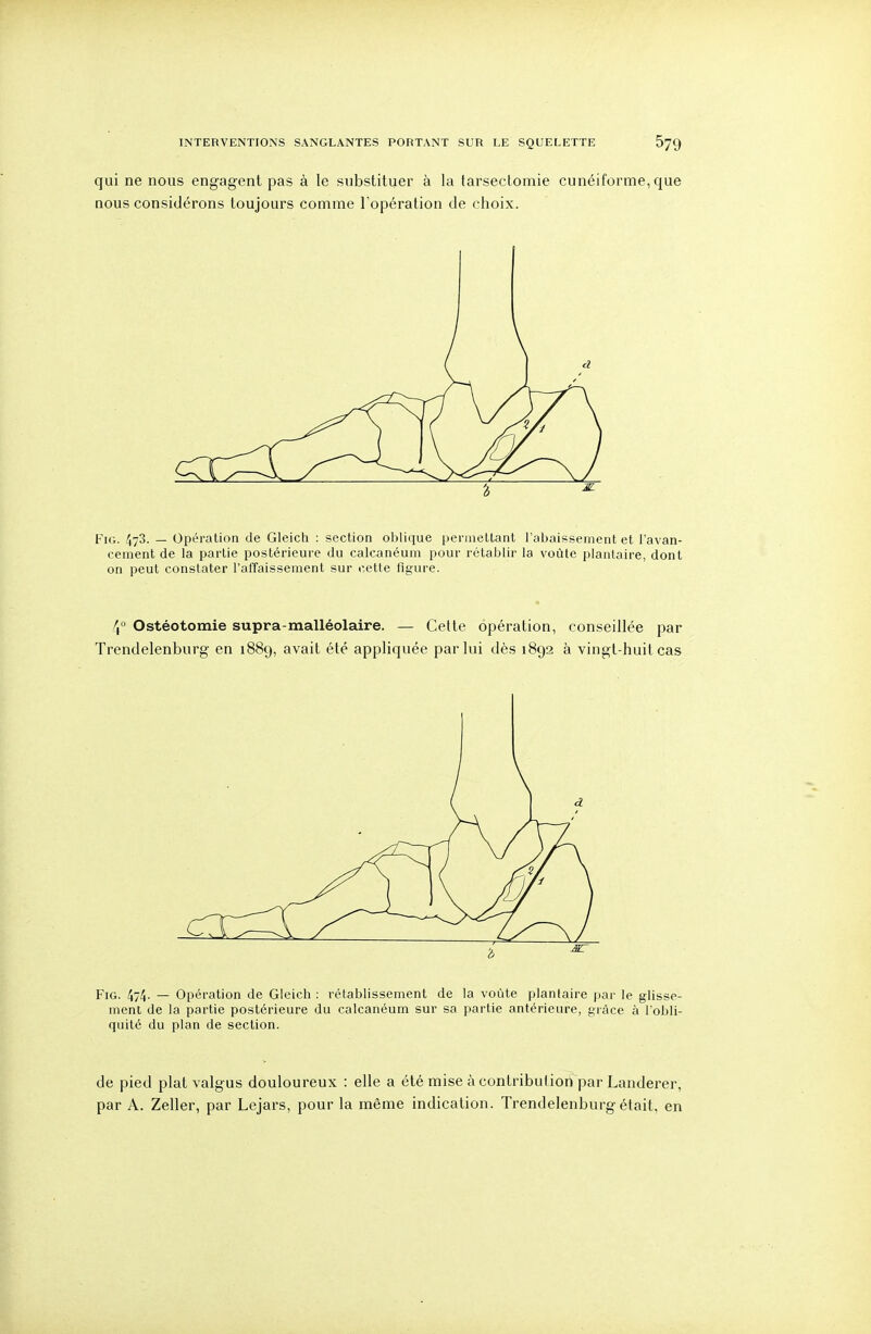 qui ne nous engagent pas à le substituer à la tarsectomie cunéiforme, que nous considérons toujours comme l'opération de choix. '6 ^ FiG. 473. — Opération de Gleich : section ol)lique penneltant l'abaissement et l'avan- cement de la partie postérieure du calcanéuni pour rétablir la voûte plantaire, dont on peut constater l'affaissement sur cette figure. 4° Ostéotomie supra-malléolaire. — Cette opération, conseillée par Trendelenburg en 1889, avait été appliquée par lui dès 189a à vingt-huit cas FiG. 474. — Opération de Gleich : rétablissement de la voûte plantaire par le glisse- ment de la partie postérieure du calcanéum sur sa partie antérieure, grâce à l'obli- quité du plan de section. de pied plat valgus douloureux : elle a été mise à contribution par Landerer, par A. Zeller, par Lejars, pour la même indication. Trendelenburg était, en