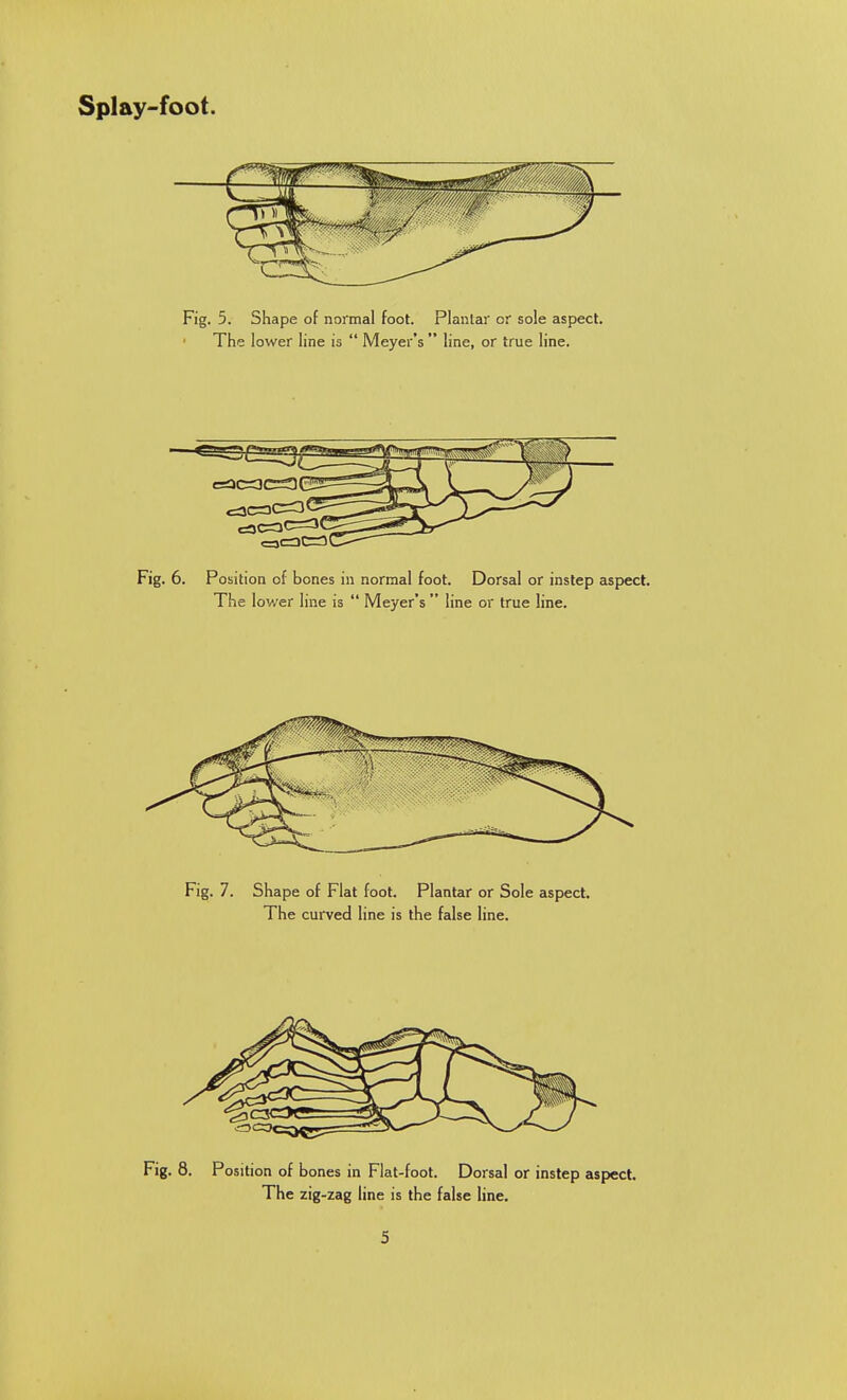 Fig. 5. Shape of normal foot. Plantar or sole aspect. The lower line is  Meyer's  line, or true line. Fig. 6. Position of bones in normal foot. Dorsal or instep aspect. The lower line is  Meyer's  line or true line. Fig. 7. Shape of Flat foot. Plantar or Sole aspect. The curved line is the false line. Fig. 8. Position of bones in Flat-foot. Dorsal or instep aspect. The zig-zag line is the false line.