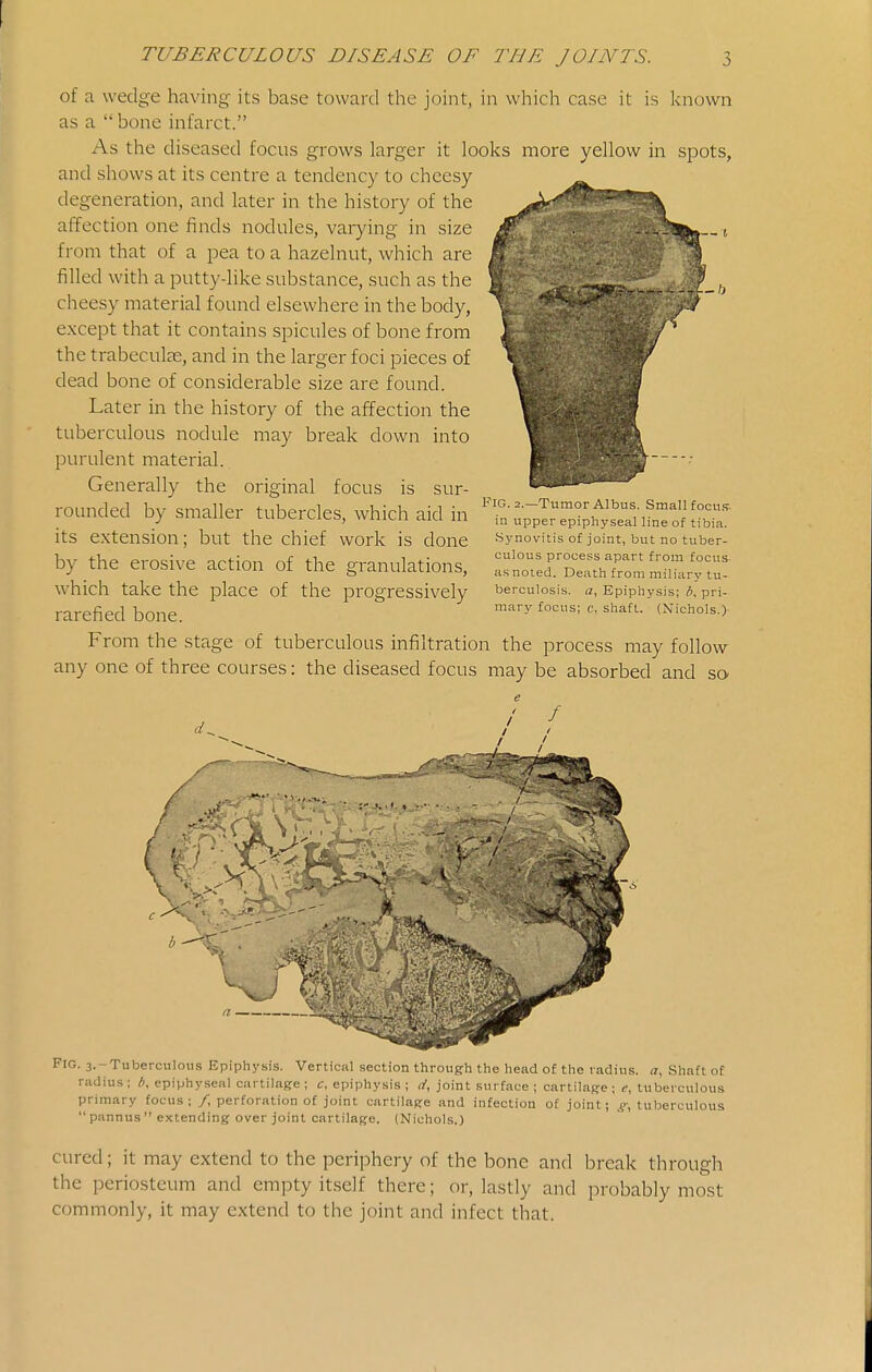 -/J of a wedge having its base toward the joint, in which case it is known as a  bone infarct. As the diseased focus grows larger it looks more yellow in spots, and shows at its centre a tendency to cheesy degeneration, and later in the history of the affection one finds nodules, varying in size from that of a pea to a hazelnut, which are filled with a putty-like substance, such as the cheesy material found elsewhere in the body, except that it contains spicules of bone from the trabeculje, and in the larger foci pieces of dead bone of considerable size are found. Later in the history of the affection the tuberculous nodule may break down into purulent material. Generally the original focus is sur- rounded by smaller tubercles, which aid in its extension; but the chief work is done by the erosive action of the granulations, which take the place of the progressively rarefied bone. From the stage of tuberculous infiltration the process may follow any one of three courses: the diseased focus may be absorbed and so Fig. 2.—Tumor Albus. Small focu.T. in upper epiphyseal line of tibia. Synovitis of joint, but no tuber- culous process apart from focus- as noted. Death from miliary tu- berculosis, a. Epiphysis; i^, pri- mary focus; c, shaft. (Nichols.) Fig. 3.-Tuberculous Epiphysis. Vertical section through the head of the radius, a, Shaft of radius ; epiphyseal cartilage ; c, epiphysis ; </, joint surface ; cartilage ; e, tuberculous primary focus ; /, perforation of joint cartilage and infection of joint; ^, tuberculous  pannus  extending over joint cartilage. (Nichols.) cured; it may extend to the periphery of the bone and break through the periosteum and empty itself there; or, lastly and probably most commonly, it may extend to the joint and infect that.