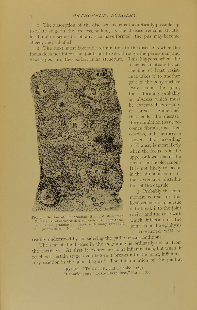 1. The absorption of the diseased focus is theoretically possible up to a late stage in the process, so long as the disease remains strictly local and no sequestra of any size have formed; the pus may become cheesy and calcified. 2. The next most favorable termination to the disease is when the focus does not infect the joint, but breaks through the periosteum and discharges into the periarticular structure. This happens when the focus is so situated that the line of least resist- ance takes it to another pait of the bony surface away from the joint, there forming probably an abscess which must be evacuated externally or break. Sometimes this ends the disease; the granulation tissue be- comes fibrous, and then osseous, and the disease is over. This, according to Krause, is most likely when the focus is in the upper or lower end of the tibia or in the olecranon.' It is not likely to occur in the hip on account of the extensive distribu- tion of the capsule. 3. Probably the com- monest course for this localized ostitis to pursue is to break into the joint cavity, and the ease with which infection of the joint from the epiphysis is produced will be readily understood by considering the pathological conditions. The seat of the disease in the beginning is ordinarily not far from the cartilage At first it excites no joint inflammation, but when it reaches a certain stage, even before it breaks into the joint, inflamma- tory reaction in the joint begins.'^ The inflammation of the joint at • Krause :  Tub. der K. und Gelenke, 1S91. 5 Lannelongue :  Coxo-tiiberculose, Paris, 18S6. Fig. 4. —Section of Tuberculous Synovial Membrane. Numerous tubercles with giant cells. Between these, cedematous granulation tissue with man.v lymphoid <ind plasma cells. (Nichols.)