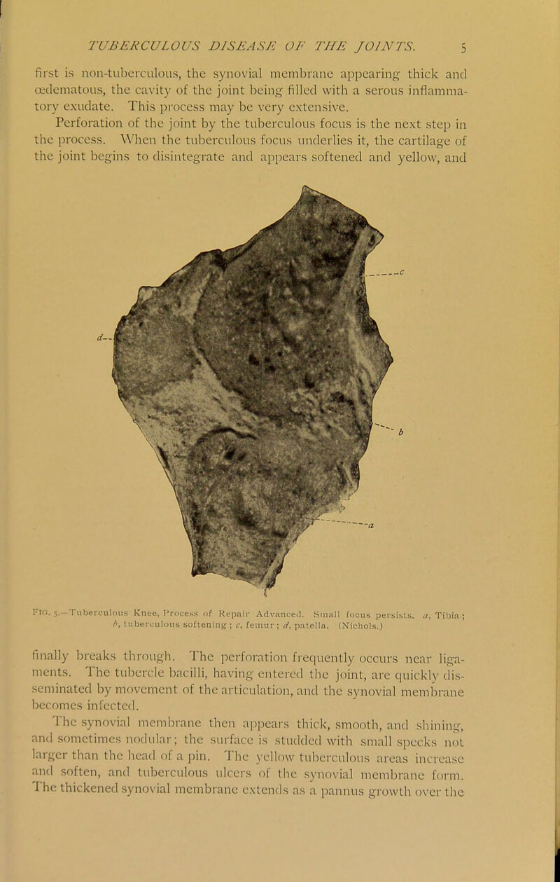 first is non-tuberculous, the synovial membrane appearing thick and oedematous, the cavity of the joint being filled with a serous inflamma- tory exudate. This process may be very extensive. Perforation of the joint by the tuberculous focus is the next step in the process. When the tuberculous focus underlies it, the cartilage of the joint begins to disintegrate and appears softened and yellow, and Fli;. 5.—Tuberculous I-Cnee, I'rocess of Repair Advanced. .Small focus persists. (/, Tibia ; tuberculous softening- ; r, femur ; patella. (Nichols.) finally breaks through. The perforation frequently occurs near liga- ments. The tubercle bacilli, having entered the joint, are quickly dis- seminated by movement of the articulation, and the synovial membrane becomes infected. The synovial membrane then appears thick, smooth, and shining, and sometimes nodular; the surface is studded with small specks not larger than the head of a pin. The yellow tuberculous areas increase and soften, and tuberculous ulcers of the synovial membrane form. The thickened synovial membrane extends as a pannus growth over the