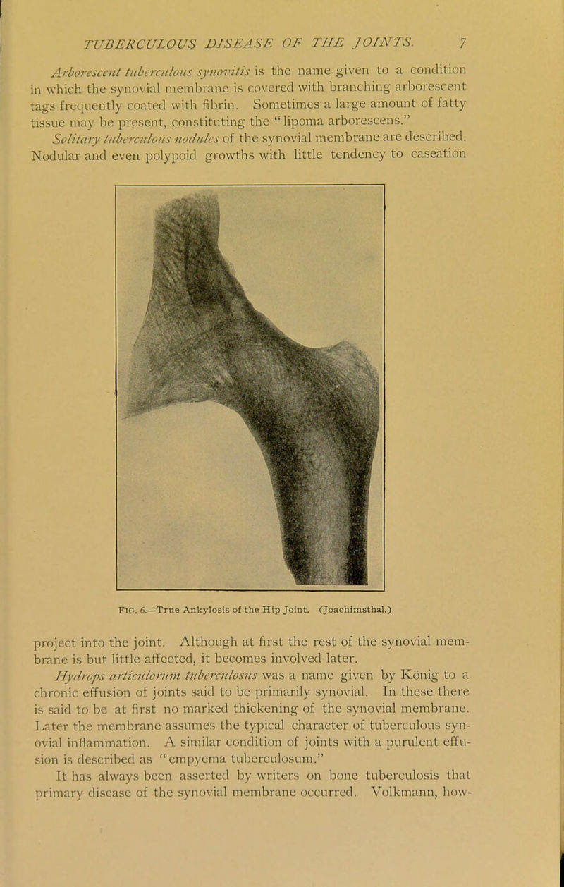 Arborescent tuberculous synovitis is the name given to a condition in which the synovial membrane is covered with branching arborescent tags frequently coated with fibrin. Sometimes a large amount of fatty tissue may be present, constituting the  lipoma arborescens. Solitary tuberculous nodules of the synovial membrane are described. Nodular and even polypoid growths with little tendency to caseation Fig. 6.—True Ankylosis of the Hip Joint. CJoachimsthal.) project into the joint. Although at first the rest of the synovial mem- brane is but little affected, it becomes involved later. Hydrops articulorum tuberculosus was a name given by Konig to a chronic effusion of joints said to be primarily synovial. In these there is said to be at first no marked thickening of the synovial membrane. Later the membrane assumes the typical character of tuberculous syn- ovial inflammation. A similar condition of joints with a purulent effu- sion is described as empyema tuberculosum. It has always been asserted by writers on bone tuberculosis that primary disease of the .synovial membrane occurred. Volkmann, how-