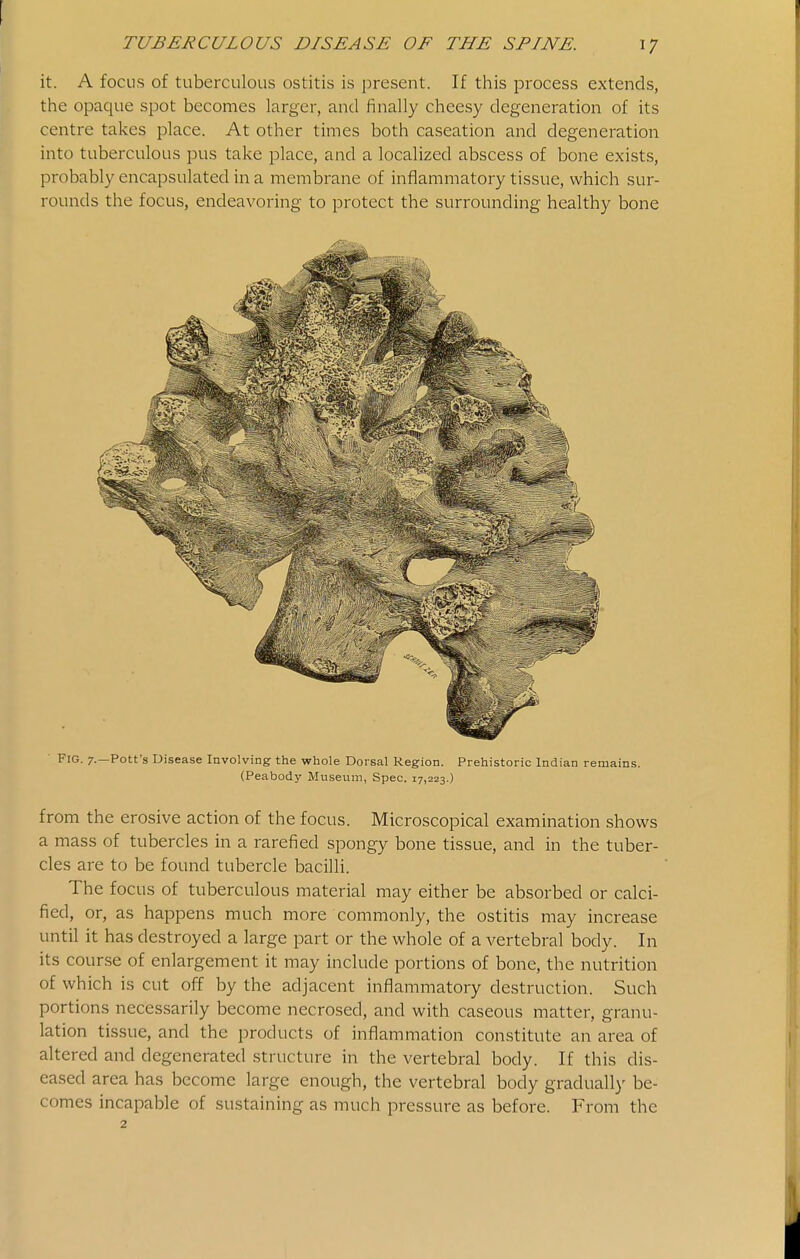 it. A focus of tuberculous ostitis is present. If this process extends, the opaque spot becomes larger, and finally cheesy degeneration of its centre takes place. At other times both caseation and degeneration into tuberculous pus take place, and a localized abscess of bone exists, probably encapsulated in a membrane of inflammatory tissue, which sur- rounds the focus, endeavoring to protect the surrounding healthy bone Fig. 7.—Pott's Disease Involving the whole Dorsal Region. Prehistoric Indian remains. (Peabody Museum, Spec. 17,223.) from the erosive action of the focus. Microscopical examination shows a mass of tubercles in a rarefied spongy bone tissue, and in the tuber- cles are to be found tubercle bacilli. The focus of tuberculous material may either be absorbed or calci- fied, or, as happens much more commonly, the ostitis may increase until it has destroyed a large part or the whole of a vertebral body. In its course of enlargement it may include portions of bone, the nutrition of which is cut off by the adjacent inflammatory destruction. Such portions necessarily become necrosed, and with caseous matter, granu- lation tissue, and the products of inflammation constitute an area of altered and degenerated structure in the vertebral body. If this dis- eased area has become large enough, the vertebral body graduall)- be- comes incapable of sustaining as much pressure as before. From the