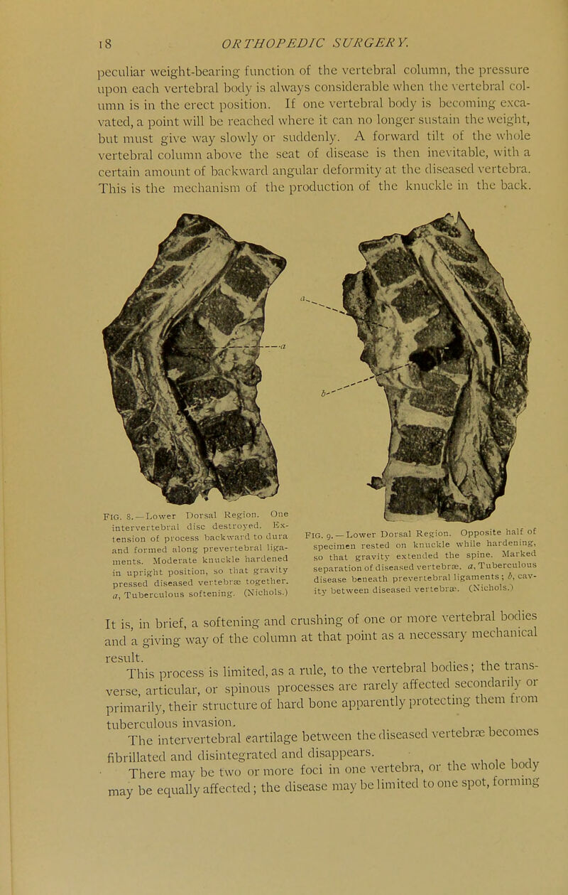 peculiar weight-bearing function of tlie vertebral column, the pressure upon each vertebral body is always considerable when the \-ertebral col- umn is in the erect position. If one vertebral body is becoming exca- vated, a point will be reached where it can no longer sustain the weight, but must give way slowly or suddenly. A forward tilt of the whole vertebral column above the seat of disease is then inevitable, with a certain amount of backward angular deformity at the diseased vertebra. This is the mechanism of the production of the knuckle in the back. Fig. 8. —Lower Dorsal Region. One intervertebral disc destroj-ed. E.'c- tension o£ process backward to dura and formed along prevertebral liga- ments. Moderate knuckle hardened in upright position, so that gravity pressed diseased vertebrae together, a, Tuberculous softening. (Nichols.) b'' FIG. 9.— Lower Dorsal Region. Opposite half of specimen rested on knuckle while hardening, so that gravity extended the spine. Marked separation of diseased vertebrae, a, Tuberculous disease beneath prevertebral ligaments; cav- ity between diseased vertebra?. (Nichols.^) It is in brief, a softening and crushing of one or more vertebral bodies and 'a giving way of the column at that point as a necessary mechanical result. , , i.1 ». This process is limited,as a rule, to the vertebral bodies; the trans- verse, articular, or spinous processes are rarely affected secondarily or primarily, their structure of hard bone apparently protecting them from tuberculous invasion. The intervertebral cartilage between the diseased vertebrae becomes fibrillated and disintegrated and disappears. , , , , There may be two or more foci in one vertebra, or the whole body may be equally affected; the disease may be limited to one spot, forming