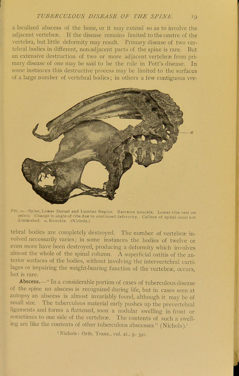 a localized abscess of the bone, or it may extend so as to involve the adjacent vertebra:. If the disease remains limited to the centre of the \ ertebra, but little deformity may result. Primary disease of two ver- tebral bodies in different, non-adjacent parts of the spine is rare. But an extensive destruction of two or more adjacent vertebrae from pri- mary disease of one may be said to be the rule in Pott's disease. In some instances this destructive process may be limited to the surfaces of a large number of vertebral bodies; in others a few contiguous ver- FlG. 10. -Spine, Lower Dorsal and Lumbar Region. Extreme knuckle. Lower ribs rest on pelvis. Cliange in angle of ribs due to continued deformity. Calibre of spinal canal not diminished, a. Knuckle. (Nichols.) tebral bodies are completely destroyed. The number of vertebree in- volved necessarily varies; in some instances the bodies of twelve or even more have been destroyed, producing a deformity which involves almost the whole of the spinal column. A superficial ostitis of the an- terior surfaces of the bodies, without involving the intervertebral carti- lages or impairing the weight-bearing function of the vertebra:, occurs, but is rare. Abscess— In a considerable portion of cases of tuberculous disease of the spine no abscess is recognized during life, but in cases seen at autopsy an abscess is almost invariably found, although it ma)- be of small size. The tuberculous material early pushes up the prevertebral ligaments and forms a flattened, soon a nodular swelling in front or sometimes to one side of the vertebrae. The contents of such a swell- ing are like the contents of other tuberculous ab.scesses  (Nichols).' 'Nichols: Orth. Trans., vol. xi., p. 391.