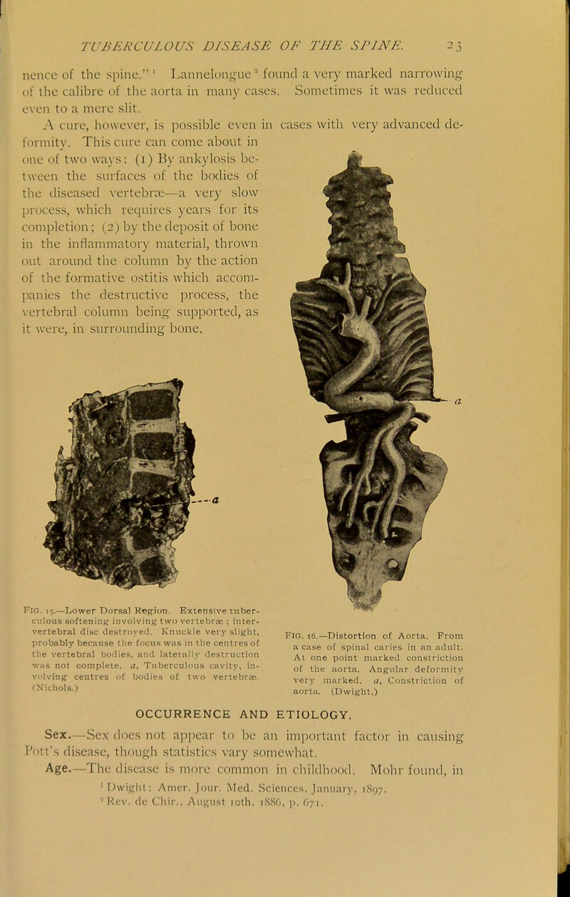 nencc of the spine. ' Lannelongue ■ found a very marked narrowing of the cahbre of the aorta in many cases. Sometimes it was reduced even to a mere sUt. A cure, however, is possible even in cases with very advanced de- formity. This cine can come about in one of two ways: (i) By ankylosis be- tween the surfaces of the bodies of the diseased vertebrae—a very slow process, which requires years for its completion; (2) by the deposit of bone in the inflammatory material, thrown out around the column by the action of the formative ostitis which accom- panies the destructive process, the vertebral column being supported, as it were, in surrounding bone. —a Fig. 15.—Lower Dorsal Region. Exten.sive tuber- culous softening involving two vertebrae ; inter- vertebral disc destroyed. Knuckle very slight, probably because the focus was in llie centres of the vertebral bodies, and laterally destruction was not complete, a, Tuberculous cavity, in- volving centres of bodies of two vertebrse. (Nichols.) Fig. 16.—Distortion of Aorta. From a case of spinal caries in an adult. At one point marked constriction of the aorta. Angular deformity very marked, a, Constriction of aorta. (Dwight.) OCCURRENCE AND ETIOLOGY. Sex.—Sex does not ajjpear to be an important factor in causing Pott's di.sease, though statistics vary somewhat. Age.—The disea.se is more common in childhood. Mohr found, in ' Dwiglit: Amcr. Jour. Med. Sciences. January, 1897. •Rev. dc Chir.. Aiif^iist loth. 1S.S6, ]j. 671.