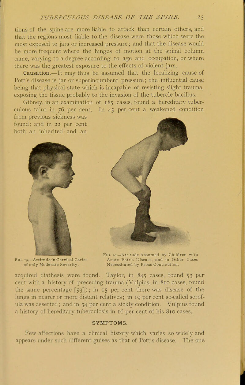 tions of the spine are more liable to attack than certain others, and that the regions most liable to the disease were those which were the most exposed to jars or increased pressure; and that the disease would be more frequent where the hinges of motion at the spinal column came, varying to a degree according to age and occupation, or where there was the greatest exposure to the effects of violent jars. Causation.—It may thus be assumed that the localizing cause of Pott's disease is jar or superincumbent pressure; the influential cause being that physical state which is incapable of resisting slight trauma, exposing the tissue probably to the invasion of the tubercle bacillus. Gibney, in an examination of 185 cases, found a hereditary tuber- culous taint in 76 per cent. In 45 per cent a weakened condition from previous sickness was ^^^^ acquired diathesis were found. Taylor, in 845 cases, found 53 per cent with a history of preceding trauma (Vulpius, in 810 cases, found the same percentage [53]); in 15 percent there was disease of the lungs in nearer or more distant relatives; in rg per cent so-called scrof- ula was asserted ; and in 34 per cent a sickly condition. Vulpius found a history of hereditary tuberculosis in 16 per cent of his 810 cases. found; and in 22 per cent both an inherited and an of only Moderate Severity Fig. 20.—Attitude Assumed by Children with Acute Pott's Disease, and in Other Cases Necessitated by Psoas Contraction. SYMPTOMS. Few affections have a clinical history which varies so widely and appears under such different guises as that of Pott's disease. The one