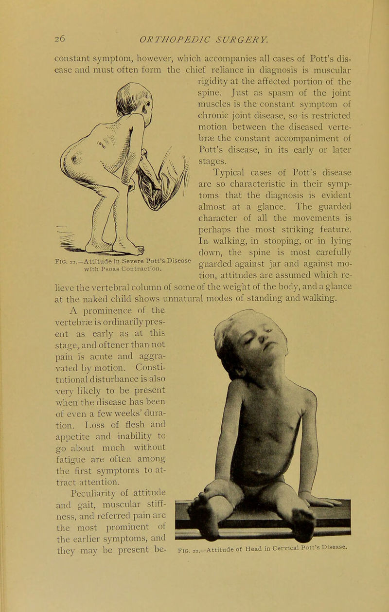 Fig. 21.—Attitude in Severe Pott's Disease with Psoas Contraction. constant symptom, however, which accompanies all cases of Pott's dis- ease and must often form the chief reliance in diagnosis is muscular rigidity at the affected portion of the spine. Just as spasm of the joint muscles is the con.stant .symptom of chronic joint disease, so is restricted motion between the diseased vcrte- brte the constant accompaniment of Pott's disease, in its early or later stages. Typical ca.ses of Pott's disease are so characteristic in their symp- toms that the diagnosis is evident almost at a glance. The guarded character of all the movements is perhaps the most striking feature. In walking, in stooping, or in lying down, the spine is most carefully guarded against jar and against mo- tion, attitudes are assumed which re- lieve the vertebral column of some of the weight of the body, and a glance at the naked child shows unnatural modes of standing and walking. A prominence of the vertebrae is ordinarily pres- ent as early as at this stage, and oftener than not pain is acute and aggra- vated by motion. Consti- tutional disturbance is also very likely to be present when the disease has been of even a few weeks' dura- tion. Loss of flesh and appetite and inability to oo about much without fatigue are often among the first .symptoms to at- tract attention. Peculiarity of attitude and gait, muscular stiff- ness, and referred pain are the most prominent of the earlier symptoms, and they may be present be- fig. 22. —Attitude of Head in Cervical Pott's Disease.