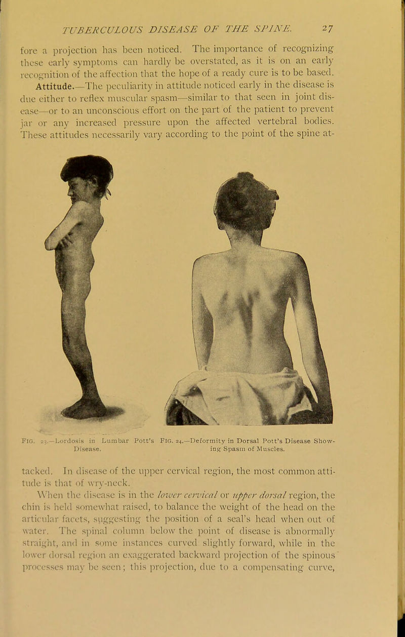fore a projection has been noticed. The importance of recognizing these early symptoms can hardly be overstated, as it is on an early recoi;nition of the affection that the hope of a ready cure is to be based. Attitude.—The peculiarity in attitude noticed early in the disease is due either to reflex muscular spasm—similar to that seen in joint dis- ease—or to an unconscious effort on the part of the patient to prevent jar or any increased pressure upon the affected vertebral bodies. These attitudes necessarily vary according to the point of the spine at- FiG. 25.—Lordosis in Lumbar Pott's Fig. 24.—Deformity in Dorsal Pott's Disease Show- Disease, ins? Spasm of Muscles. tacked. In disease of the upper cervical region, the most common atti- tude is that of wry-neck. When the disease is in the lower cervical or upper dorsal region, tlie chin is held somewhat raised, to balance the weight of the head on the articular facets, siiggesting the position of a seal's head when out of water. The sjiinal column below the point of disease is abnormal!}' straight, and in some instances curved slightly forward, while in the lower dorsal region an e.xaggerated backward projection of the spinous' processes may be seen; this ]-)rojection, due to a compensating curve.
