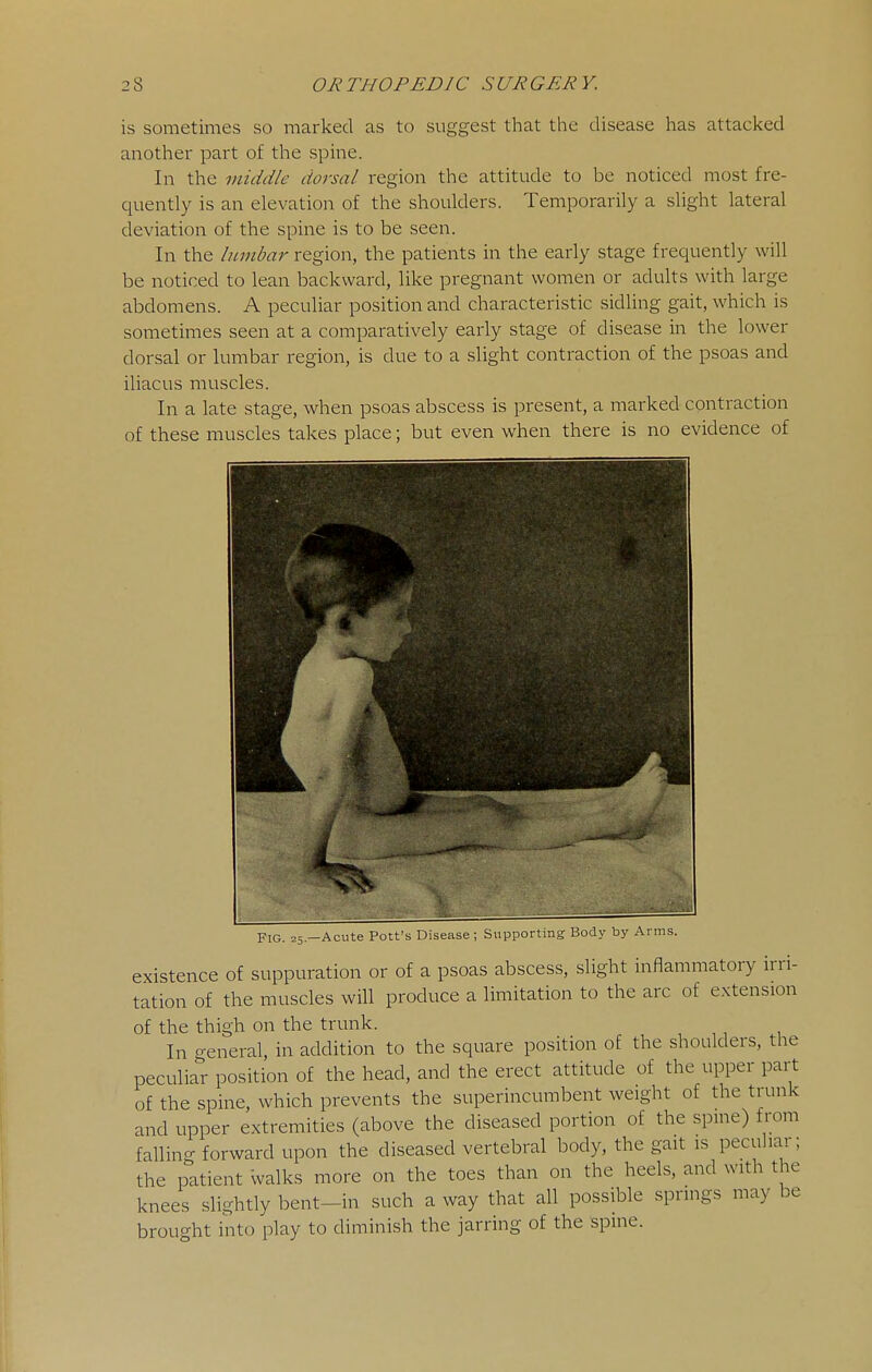 is sometimes so marked as to suggest that the disease has attacked another part of the spine. In the middle dorsal region the attitude to be noticed most fre- quently is an elevation of the shoulders. Temporarily a slight lateral deviation of the spine is to be seen. In the hnnbar region, the patients in the early stage frequently will be noticed to lean backward, like pregnant women or adults with large abdomens. A peculiar position and characteristic sidling gait, which is sometimes seen at a comparatively early stage of disease in the lower dorsal or lumbar region, is due to a slight contraction of the psoas and iliacus muscles. In a late stage, when psoas abscess is present, a marked contraction of these muscles takes place; but even when there is no evidence of Fig. 25.—Acute Pott's Disease ; Supporting Body by Arms. existence of suppuration or of a psoas abscess, slight inflammatory irri- tation of the muscles will produce a limitation to the arc of extension of the thigh on the trunk. In general, in addition to the square position of the shoulders, the peculiar position of the head, and the erect attitude of the upper part of the spine, which prevents the superincumbent weight of the trunk and upper extremities (above the diseased portion of the spine) from falling forward upon the diseased vertebral body, the gait is peculiar; the patient walks more on the toes than on the heels, and with the knees slightly bent-in such a way that all possible springs may be brought into play to diminish the jarring of the spine.