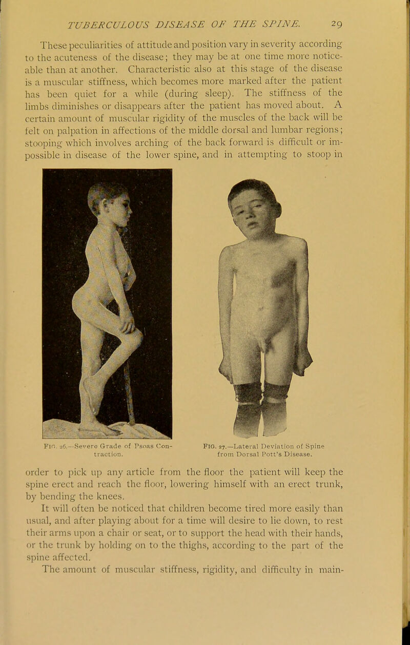 These peculiarities of attitude and position vary in severity according to tlie acuteness of the disease; they may be at one time more notice- able than at another. Characteristic also at this stage of the disease is a muscular stiffness, which becomes more marked after the patient has been quiet for a while (during sleep). The stiffness of the limbs diminishes or disappears after the patient has moved about. A certain amount of muscular rigidity of the muscles of the back will be felt on palpation in affections of the middle dorsal and lumbar regions; stooping which involves arching of the back forward is difficult or im- possible in disease of the lower spine, and in attempting to stoop in Fi'i .Se^'erc Gi atle of Psoas (oti- FiG. 27.—Lateral Deviation o£ Spine traction. from Dorsal Pott's Disease. order to pick up any article from the floor the patient will keep the spine erect and reach the floor, lowering himself with an erect trunk, by bending the knees. It will often be noticed that children become tired more easily than usual, and after playing about for a time will desire to lie down, to rest their arms upon a chair or seat, or to support the head with their hands, or the trunk by holding on to the thighs, according to the part of the spine affected. The amount of muscular stiffness, rigidity, and difficulty in main-