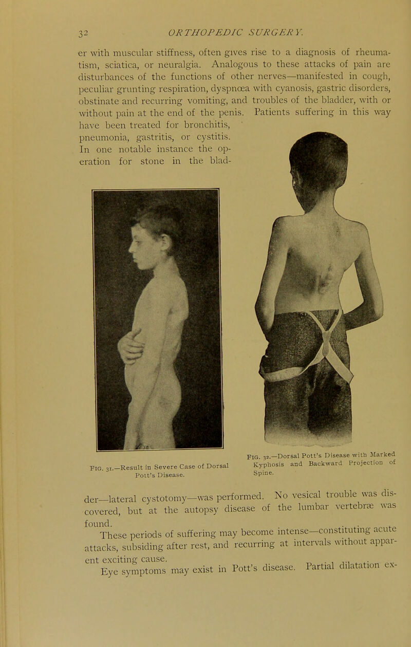 er with muscular stiffness, often gives rise to a diagnosis of rheuma- tism, sciatica, or neuralgia. Analogous to these attacks of pain are disturbances of the functions of other nerves—manifested in cough, peculiar grunting respiration, dyspnoea with cyanosis, gastric disorders, obstinate and recurring vomiting, and troubles of the bladder, with or without pain at the end of the penis. Patients suffering in this way have been treated for bronchitis, pneumonia, gastritis, or cystitis. In one notable instance the op- eration for stone in the blad- FlG. 31.—Result in Severe Case of Dorsal Poll's Disease. Pjq 32._Dorsal Pott's Disease witli Marked Kyphosis and Backward Projection o£ Spine. der-lateral cystotomy-was performed. No vesical trouble was dis- covered, but at the autopsy disease of the lumbar vertebra was found. . . These periods of suffering may become intense-constituting acute attacks, subsiding after rest, and recurring at intervals without appar- ent exciting cause. . , ,-i . Eye symptoms may exist in Pott's disease. Partial dilatation cx-