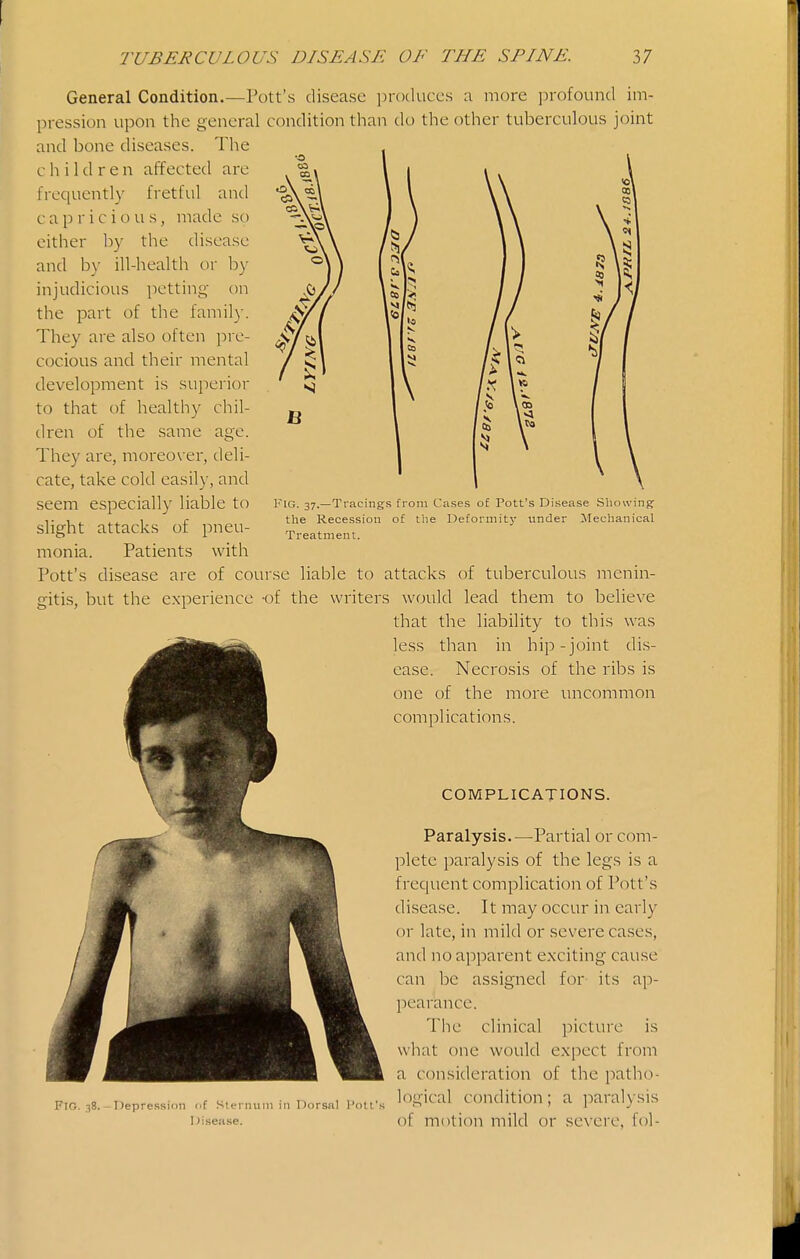 to I Fig. 37.—Tracings from Cases of Pott's Disease Showing' the Recession of the Deformitj- under Mechanical Treatment. General Condition.—Pott's disease produces a more profound im- pression upon the general condition than do the other tuberculous joint and bone diseases. The children affectetl are frequently fretful and capricious, made so cither by the disease and by ill-health or by injudicious petting on the iDart of the family. They are also often pre- cocious and their mental development is superior to that of healthy chil- dren of the .same age. They are, moreo\'er, deli- cate, take cold easily, and seem especially liable to slight attacks of pneu- monia. Patients with Pott's disease are of course liable to attacks of tuberculous menin- gitis, but the experience -of the writers would lead them to believe that the liability to this was less than in hip-joint dis- ease. Necrosis of the ribs is one of the more uncommon complications. COMPLICATIONS. Paralysis.—^Partial or com- plete paralysis of the legs is a frequent complication of Pott's disease. It may occur in early or late, in mild or severe ca.ses, and no apparent exciting cause can be assigned for its ap- pearance. The clinical picture is what one would expect from a consideration of the patho- logical condition; a paralysis of motion mild or severe, fol- FtG. 38. -Depression of Sterinim in Dorsal Pott's Disease.