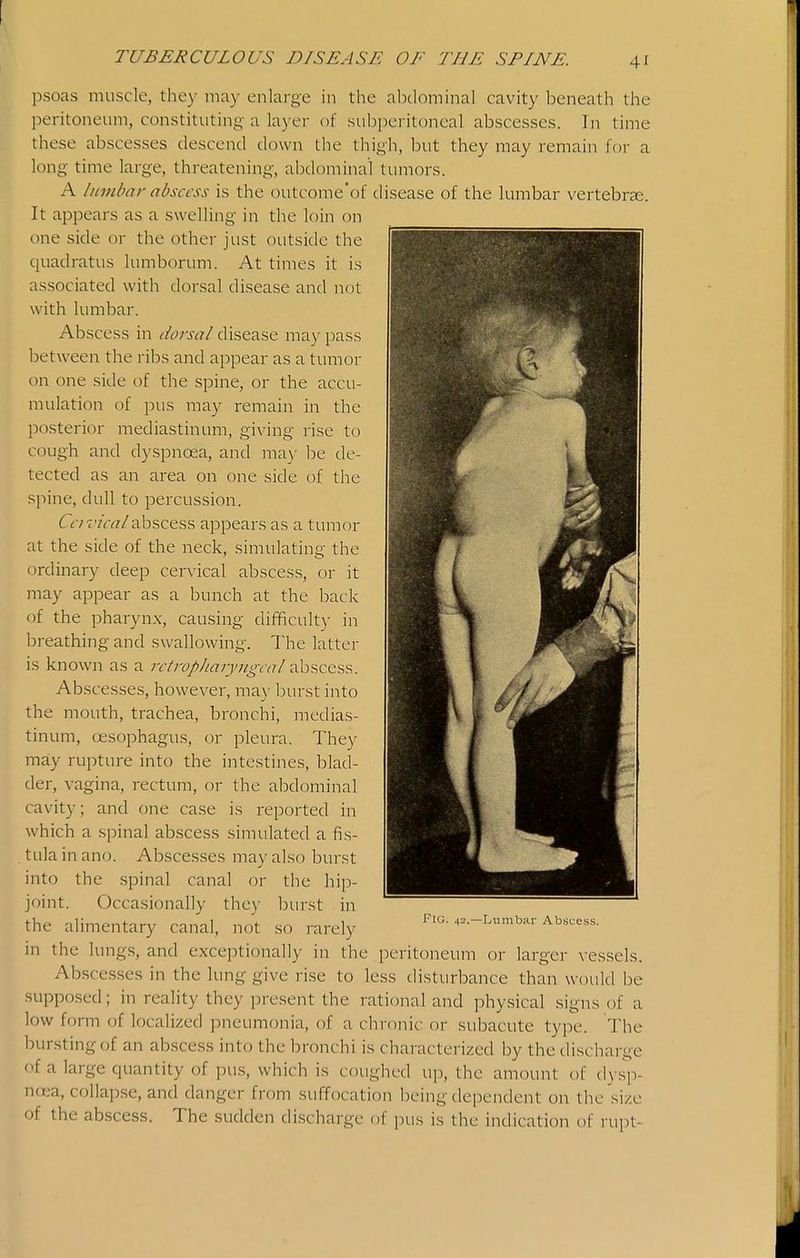 4^ psoas muscle, they may enlarge in the abdominal cavity beneath the peritoneum, constituting a layer of subperitoneal abscesses. In time these abscesses descend down the thigh, but they may remain for a long time large, threatening, abdominal tumors. A lumbar abscess is the outcome'of disease of the lumbar vertebrae. It appears as a swelling in the loin on one side or the other just outside the quadratus lumborum. At times it is associated with dorsal disease and not with lumbar. Abscess in dorsal disease may pass between the ribs and appear as a tumor on one side of the spine, or the accu- mulation of pus may remain in the posterior mediastinum, giving rise to cough and d)'spnoea, and ma)- be de- tected as an area on one side of the spine, dull to percussion. Ccivicalabscess appears as a tumor at the side of the neck, simulating the ordinary deep cervical abscess, or it may appear as a bunch at the back of the pharynx, causing difficult}' in breathing and swallowing. The latter is known as a irtrop/iaryngral ^.hnQtii?,. Abscesses, however, may burst into the mouth, trachea, bronchi, medias- tinum, oesophagus, or pleura. They may rupture into the intestines, blad- der, vagina, rectum, or the abdominal cavity; and one case is reported in which a spinal abscess simulated a fis- tula in ano. Abscesses may also burst into the spinal canal or the hip- joint. Occasionally they burst in the alimentary canal, not so rarely in the lungs, and exceptionally in the peritoneum or larger vessels. Abscesses in the lung give rise to less disturbance than would be supposed; in reality they present the rational and physical signs of a low form of localized pneumonia, of a chronic or subacute type. The bursting of an abscess into the bronchi is characterized by the discharge of a large quantity of pus, which is coughed up, the amount of dys^p- nrea, collapse, and danger from suffocation being dependent on the size of the abscess. The sudden discharge of pus is the indication of rupt- Fig. 42.—Lumbar Abscess.