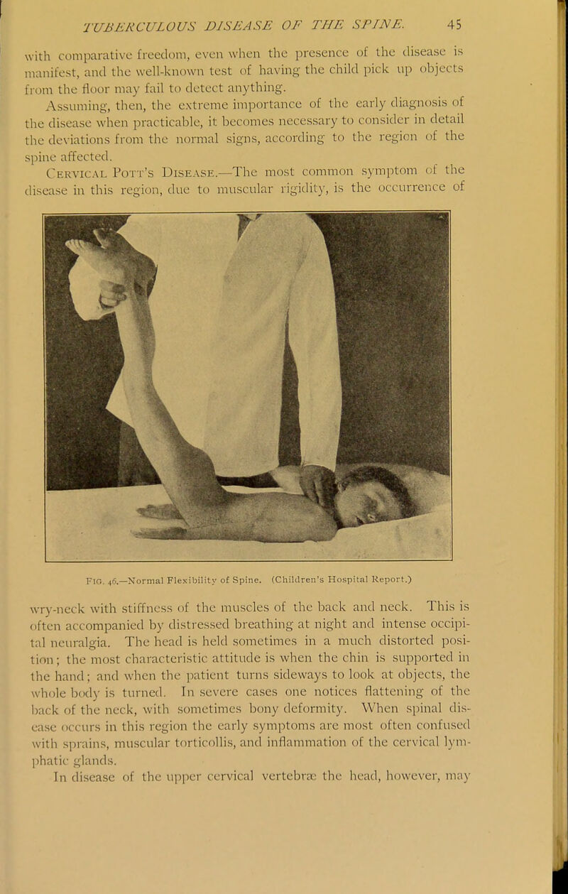with comparative freedom, even when the presence of the disease is manifest, and the well-known test of having the child pick up objects from the floor may fail to detect anything. Assuming, then, the extreme importance of the early diagnosis of the disease when practicable, it becomes necessary to consider in detail the deviations from the normal signs, according to the region of the spine affected. Cervical Pott's Disease.—The most common symptom of the disease in this region, due to muscular rigidit)-, is the occurrence of Fig. 46.—Normal Fles-ibility of Spine. (Children's Hospital Report.) wry-neck with stiffness of the muscles of the back and neck. This is often accompanied by distressed breathing at night and intense occipi- tal neuralgia. The head is held sometimes in a much distorted posi- tion ; the most characteristic attitude is when the chin is supported in the hand; and when the patient turns sideways to look at objects, the whole body is turned. In severe cases one notices flattening of the back of the neck, with sometimes bony deformity. When spinal dis- ea.se occurs in this region the early .symptoms are most often confused with sprains, muscular torticollis, and inflammation of the cervical lym- phatic glands. In disease of the upper cervical vertebrae the head, however, may