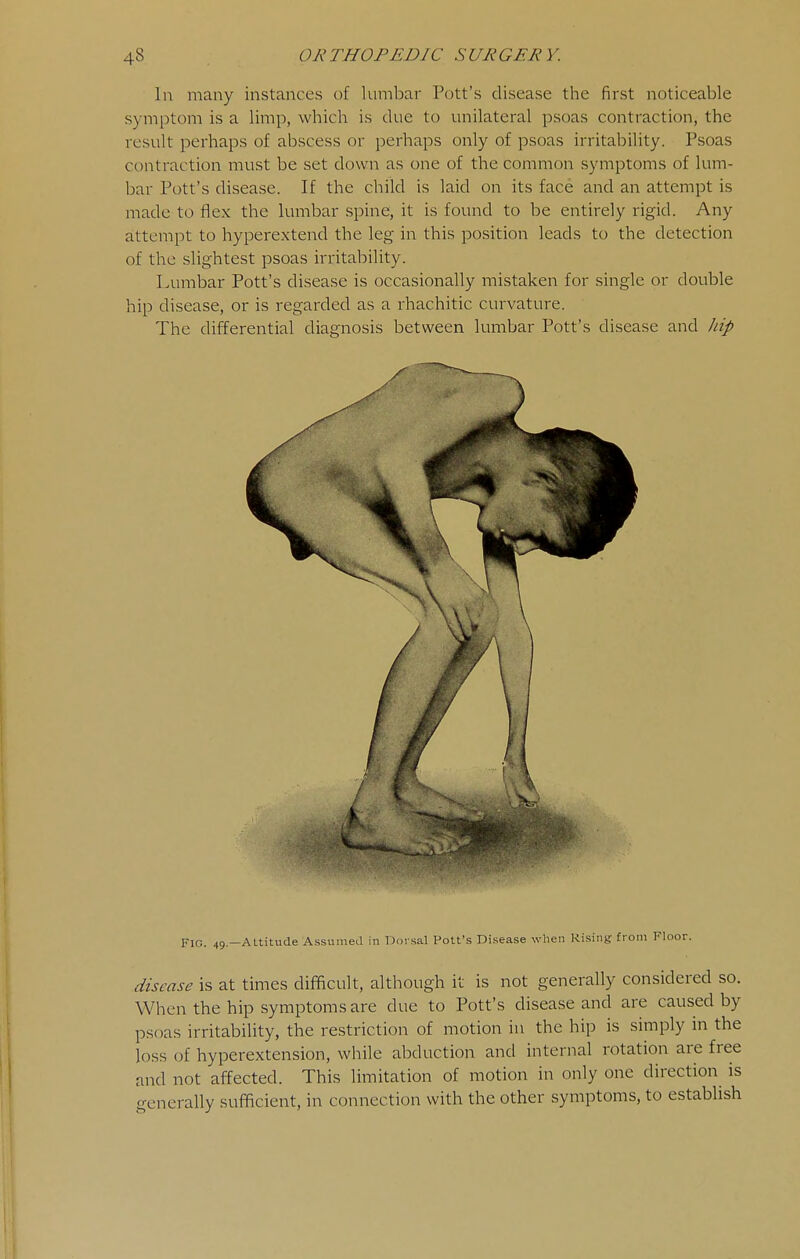 In many instances of lumbar Pott's disease the first noticeable symptom is a limp, which is due to unilateral psoas contraction, the result perhaps of abscess or perhaps only of psoas irritability. Psoas contraction must be set down as one of the common symptoms of lum- bar Pott's disease. If the child is laid on its face and an attempt is made to flex the lumbar spine, it is found to be entirely rigid. Any attempt to hyperextend the leg in this position leads to the detection of the slightest psoas irritability. Lumbar Pott's disease is occasionally mistaken for single or double hip disease, or is regarded as a rhachitic curvature. The differential diagnosis between lumbar Pott's disease and Zap Fig. 49.—Altitude Assumed in Dorsal Pott's Disease when Rising from Floor. disease is at times difficult, although it is not generally considered so. When the hip symptoms are due to Pott's disease and are caused by psoas irritability, the restriction of motion in the hip is simply in the loss of hyperextcnsion, while abduction and internal rotation are free and not affected. This limitation of motion in only one direction is generally sufficient, in connection with the other symptoms, to establish