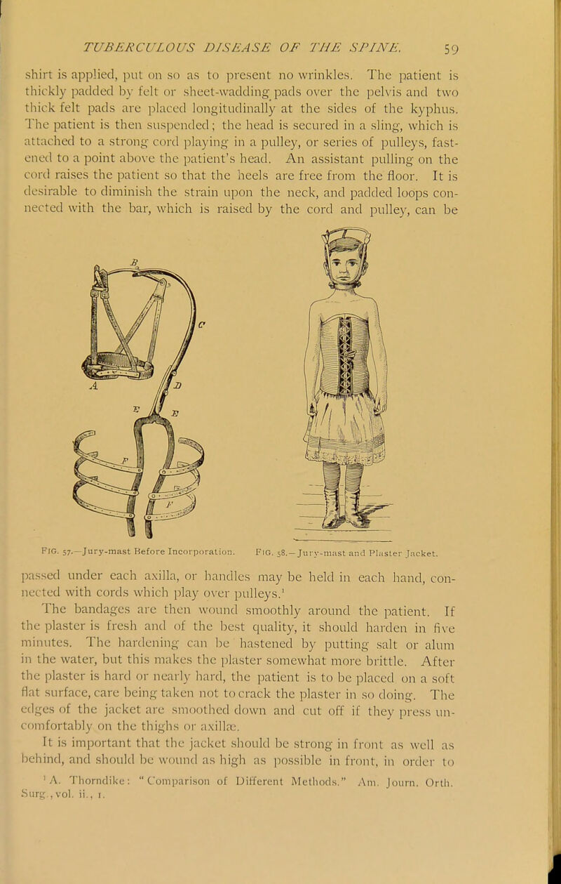 shirt is applied, put on so as to present no wrinkles. The patient is thickly padded by felt or sheet-wadding pads over the pelvis and two thick felt pads are placed longitudinally at the sides of the kyphus. The patient is then suspended; the head is secured in a sling, which is attached to a strong cord playing in a pulley, or series of pulleys, fast- ened to a point above the patient's head. An assistant pulling on the cord raises the patient so that the heels are free from the floor. It is desirable to diminish the strain upon the neck, and padded loops con- nected with the bar, which is raised by the cord and pulley, can be Fig. 57.—Jury-mast Before Incorporation. FiG. 58.-Jury-mast and Plaster Jacket. passed under each a.xilla, or handles may be held in each hand, con- nected with cords which play over pulleys.' The bandages are then wound smoothly around the patient. If the plaster is fresh and of the best quality, it should harden in five minutes. The hardening can be hastened by putting salt or alum in the water, but this makes the plaster somewhat more brittle. After the plaster is hard or nearly hard, the patient is to be placed on a soft flat surface, care being taken not to crack the plaster in so doing. The edges of the jacket are smoothed down and cut off if they press un- comfortably on the thighs or a.xillas. It is important that the jacket should be strong in front as well as behind, and should be wound as high as possible in front, in order to 'A. Thorndike: Comparison of Different Methods. Am. Journ. Orth. Surg , vol. ii., i.