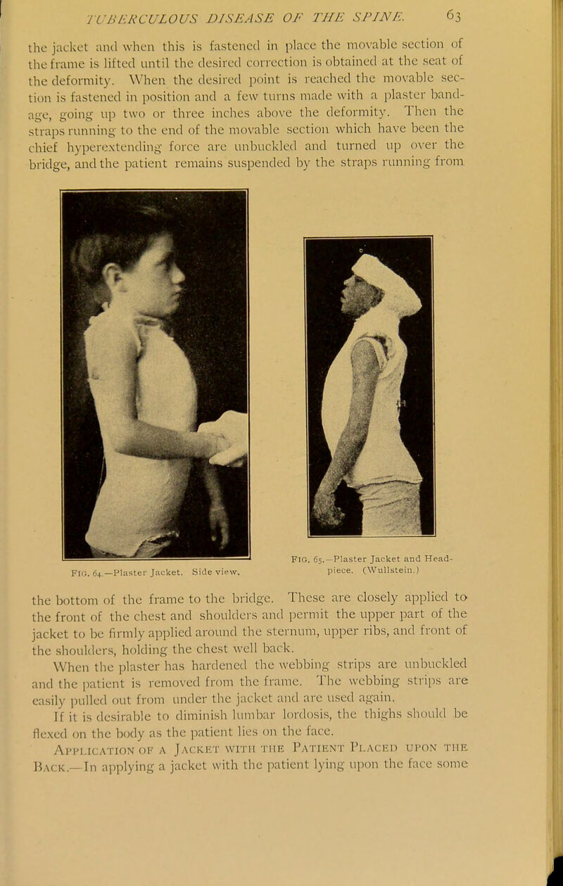 the jacket and when this is fastened in place the movable section of the frame is lifted until the desired correction is obtained at the seat of the deformity. When the desired point is i-eached the movable sec- tion is fastened in position and a few turns made with a plaster band- age, going up two or three inches above the deformity. Then the straps running to the end of the movable section which have been the chief hyperextending force are unbuckled and turned up over the bridge, and the patient remains suspended by the straps running from Fl<;. 64.—Plaster Jacket. Side view. piece. (Wullstein.) the bottom of the frame to the bridge. These are closely applied to the front of the chest and shoulders and jiermit the upper part of the jacket to be firmly applied around the sternum, upper ribs, and front of the shoulders, holding the chest well back. When the plaster has hardened the webbing strips are unbuckled and the patient is removed froni the frame. The webbing strips are easily pulled out from under the jacket and are used again. If it is desirable to diminish lumbar lordosis, the thighs should be flexed on the b(xly as the patient lies on the face. Application of a Jacket with the Patient Placed upon the liACK.— In applying a jacket with the patient lying upon the face some