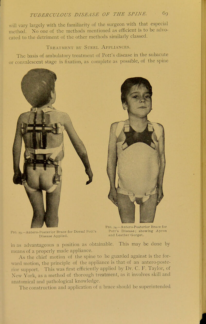 will \'ary largely with the familiarity of the surgeon with that especial method. No one of the methods mentioned as efficient is to be advo- cated to the detriment of the other methods similarly classed. Treatment by Steel Appliances. The basis of ambulatory treatment of Pott's disease hi the subacute or convalescent stage is fixation, as complete as possible, of the spine Fro. 73.-Antero-Fosterior Brace for Dorsal Pott's Pott's Disease; showing Apron Disease Applied. and Leather Gorget. in as advantageous a position as obtainable. This may be done by means of a properly made appliance. As the chief motion of the spine to be guarded against is the for- ward motion, the principle of the appliance is that of an antero-poste- rior support. This was first efficiently applied by Dr. C. F. Taylor, of New York, as a method of thorough treatment, as it involves skill and anatomical and pathological knowledge. The construction and application of a brace should be superintended
