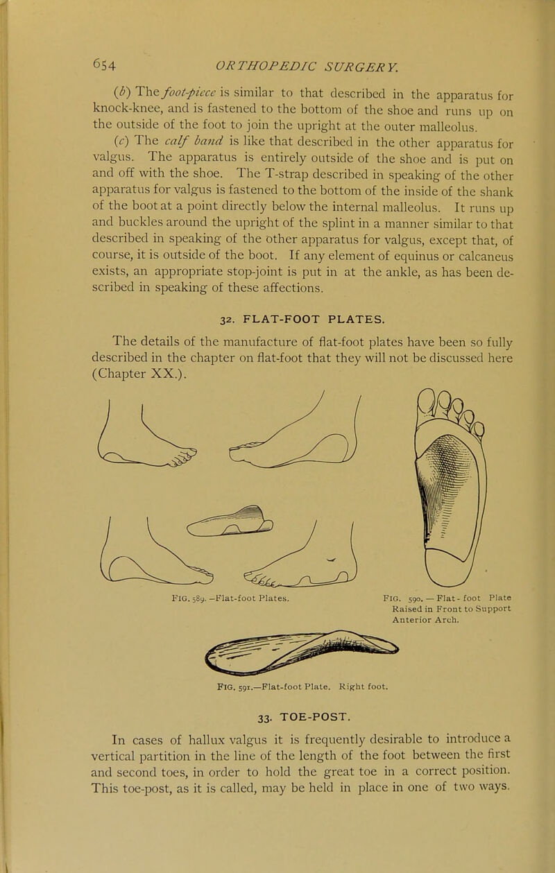 (d) lYi^ foot-piece is similar to that described in the apparatus for knock-knee, and is fastened to the bottom of the shoe and runs up on the outside of the foot to join the upright at the outer malleokis. {c) The calf band is like that described in the other apparatus for valgus. The apparatus is entirely outside of the shoe and is put on and off with the shoe. The T-strap described in speaking of the other apparatus for valgus is fastened to the bottom of the inside of the shank of the boot at a point directly below the internal malleolus. It runs up and buckles around the upright of the splint in a manner similar to that described in speaking of the other apparatus for valgus, except that, of course, it is outside of the boot. If any element of equinus or calcaneus exists, an appropriate stop-joint is put in at the ankle, as has been de- scribed in speaking of these affections. 32. FLAT-FOOT PLATES. The details of the manufacture of flat-foot plates have been so fully described in the chapter on flat-foot that they will not be discussed here (Chapter XX.). Fig. 589.-Flat-foot Plates. FiG. 590. — Flat - foot Plate Raised in Front to Support Anterior Arch. Fig. 591.—Flat-foot Plate. Right foot. 33. TOE-POST. In cases of hallux valgus it is frequently desirable to introduce a vertical partition in the line of the length of the foot between the first and second toes, in order to hold the great toe in a correct position. This toe-post, as it is called, may be held in place in one of two ways.