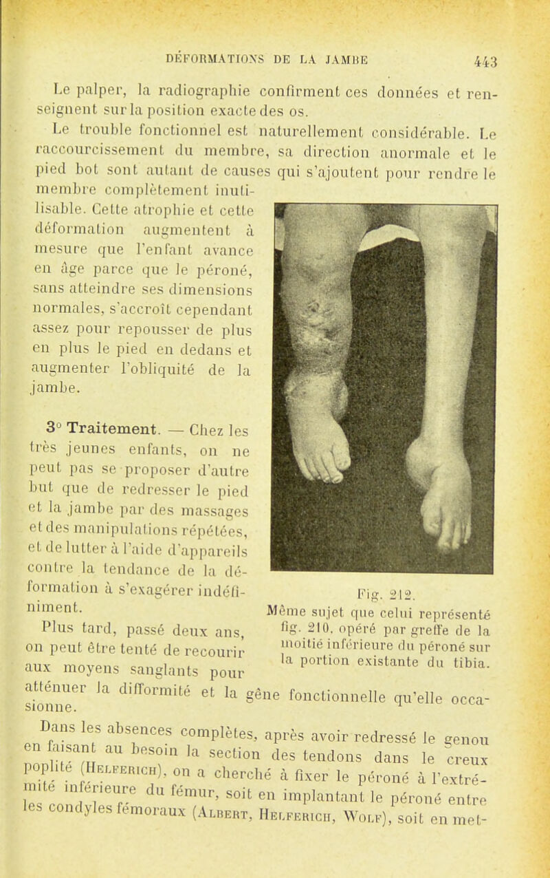 Le palper, la radiographie confirment ces données et ren- seignent sur la position exacte des os. Le trouble fonctionnel est naturellement considérable. Le raccourcissement du membre, sa direction anormale et le pied bot sont autant de causes qui s'ajoutent pour rendre le membre complètement inuti- lisable. Cette atrophie et cette déformation augmentent à mesure que l'enfant avance en âge parce que le péroné, sans atteindre ses dimensions normales, s'accroît cependant assez pour repousser de plus en plus le pied en dedans et augmenter l'obliquité de la jambe. Fig. 3° Traitement. — Chez les très jeunes enfants, on ne peut pas se proposer d'autre but que de redresser le pied et la jambe par des massages et des manipulations répétées, et de lutter à l'aide d'appareils contre la tendance de la dé- formation à s'exagérer indéfi- niment. Plus tard, passé deux ans, on peut être tenté de recourir aux moyens sanglants pour atténuer la difformité et la gêne fonctionnelle qu'elle occa- sionne. ^ Dans les absences complètes, après avoir redressé le genou en fa.san au beso.n la section des tendons dans le creux pophte Hel.erich), on a cherché à fixer le péroné à l'extré- -mte m eneure du fémur, soit en implantant le péroné entre les condyles fémoraux (Albert, Helferich, Wole) soit en met- Même sujet que celui représenté fig. 210. opéré par greffe de la inoilié inférieure du péroné sur la portion e.Kistante du tibia.