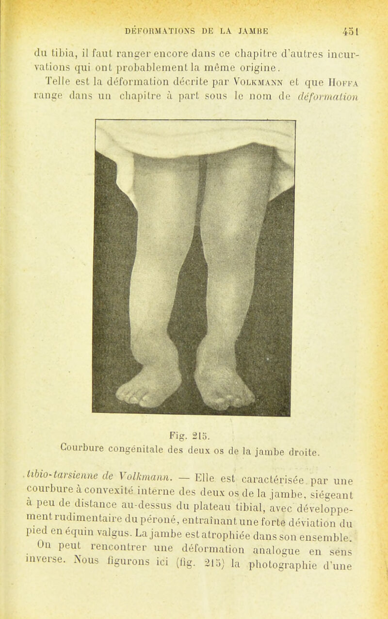 du tibia, il faut ranger encore dans ce chapitre d'autres incur- vations qui ont jjrobablement la même origine. Telle est la déformation décrite par Volkmann et que Hoffa x'ange dans un cliapitre à part sous le nom de dcformalion Fig. 215. Courbure congénitale des deux os de la jambe droite. . lîbio-tarsienne de Volkmann. - Elle est caractérisée par une courbure à convexité interne des deux os de la jambe, siégeant a peu de distance au-dessus du plateau tibial, avec développe- ment rudimentaire du péroné, entraînant une forte déviation du pied en équin valgus. La jambe est atrophiée dans son ensemble On peut rencontrer une déformation analogue en séns inverse. Nous figurons ici (lig. 21o) la photographie d'une