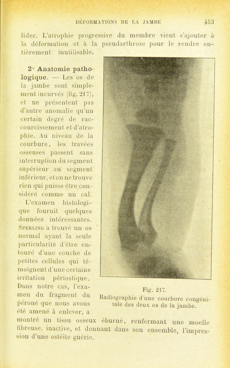 lider. L'alropliie progressive du membre vient s'ajouter la déformation et à la pseudarLhrose pour le rendre eu lièrement inutilisable. 2° Anatomie patho- logique. — Les os de la jambe sont simple- ment incurvés (ilg. 217), et ne présentent pas d'autre anomalie qu'un certain degré de rac- courcissement et d'atro- phie. Au niveau de la courbure, les travées osseuses passent sans interruption du segment supérieur au segment inférieur, étonne trouve rien qui puisse être con- sidéré comme un cal. L'examen histologi- que fournit quelques données intéressantes. Sperling a trouvé un os normal ayant la seule particularité d'être en- touré d'une couche de petites cellules qui té- moignent d'une certaine •irritation périostique. Dans notre cas, l'exa- men du fragment du péroné que nous avons été amené à enlever, a Fig. 217. Radiographie d'une courbure congéni- tale des deux os de la jambe. montré un tissu osseux éburné, renfermant une moelle libreuse, inaclive, et donnant dans son ensemble, l'impres- sion d'une ostéite guérie.