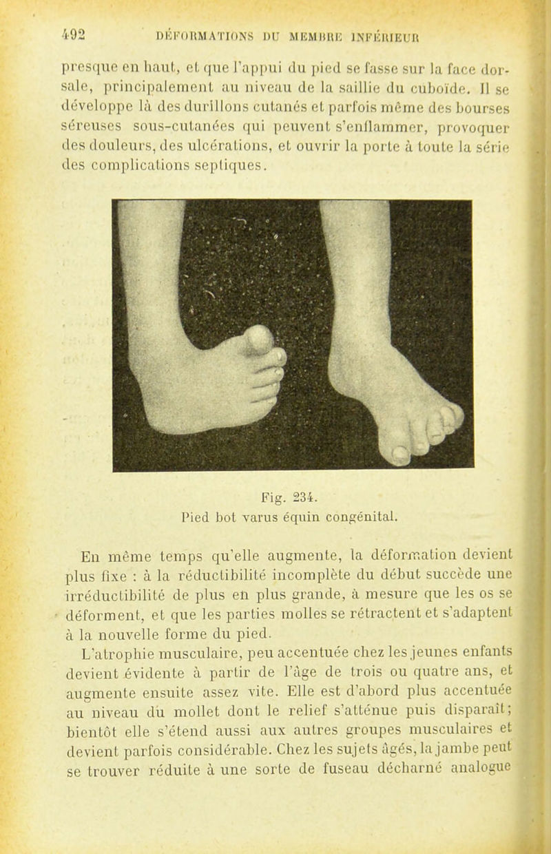 presque en haut, el, ([ue l'appui du pied se fasse sur la face dor- sale, principalemenl au niveau de la saillie du cuboïde. 11 se développe là des durillons cutanés et parfois môme des bourses séreuses sous-cutanées qui peuvent s'enllammer, provoquer des douleurs, des ulcérations, et ouvrir la porte à toute la série des complications sepliques. Fig. 234. Pied bot varus éqviin congénital. En même temps qu'elle augmente, la déformation devient plus fixe : à la réduclibilité incomplète du début succède une irréductibilité de plus en plus grande, à mesure que les os se déforment, et que les parties molles se rétractent et s'adaptenl à la nouvelle forme du pied. L'atrophie musculaire, peu accentuée chez les jeunes enfants devient évidente h partir de l'âge de trois ou quatre ans, et augmente ensuite assez vite. Elle est d'abord plus accentuée au niveau dii mollet dont le relief s'atténue puis disparaît; bientôt elle s'étend aussi aux autres groupes musculaires et devient parfois considérable. Chez les sujets tigés, la jambe peut se trouver réduite à une sorte de fuseau décharné analogue