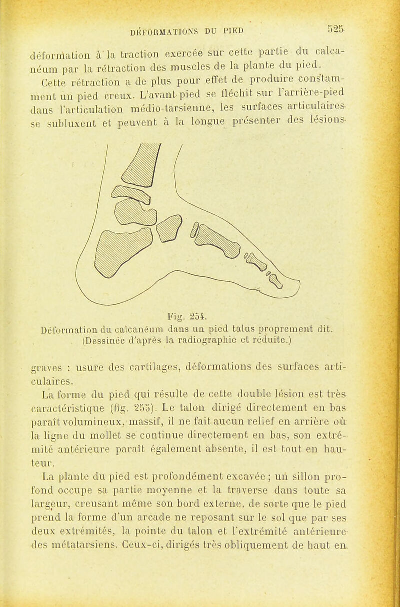 déronilaliou à la traction exercée sur cette partie du calca- néum par la rétraction des muscles de la plante du pied. Cette rétraction a de plus pour elTet de produire constam- ment un pied creux. L'avant-pied se fléchit sur larrière-pied dans larticulation médio-tarsienne, les surfaces articulaires- se subluxent et peuvent à la longue présenter des lésions- Fig. 254. Déformation du calcanéum dans un pied talus proprement dit. (Dessinée d'après la radiographie et réduite.) graves : usure des cartilages, déformations des surfaces arti- culaires. La forme du pied qui résulte de cette double lésion est très caractéristique (fig. 25o). Le talon dirigé directement en bas paraît volumineux, massif, il ne fait aucun relief en arrière où la ligne du mollet se continue directement en bas, son extré- mité antérieure paraît également absente, il est tout en hau- teur. La plante du pied est profondément excavée ; un sillon pro- fond occupe sa partie moyenne et la traverse dans toute sa largeur, creusant même son bord externe, de sorte que le pied prend la forme d'un arcade ne reposant sur le sol que par ses deux extrémités, la pointe du talon et l'extrémité antérieure des métatarsiens. Ceux-ci, dirigés très obliquement de haut en.