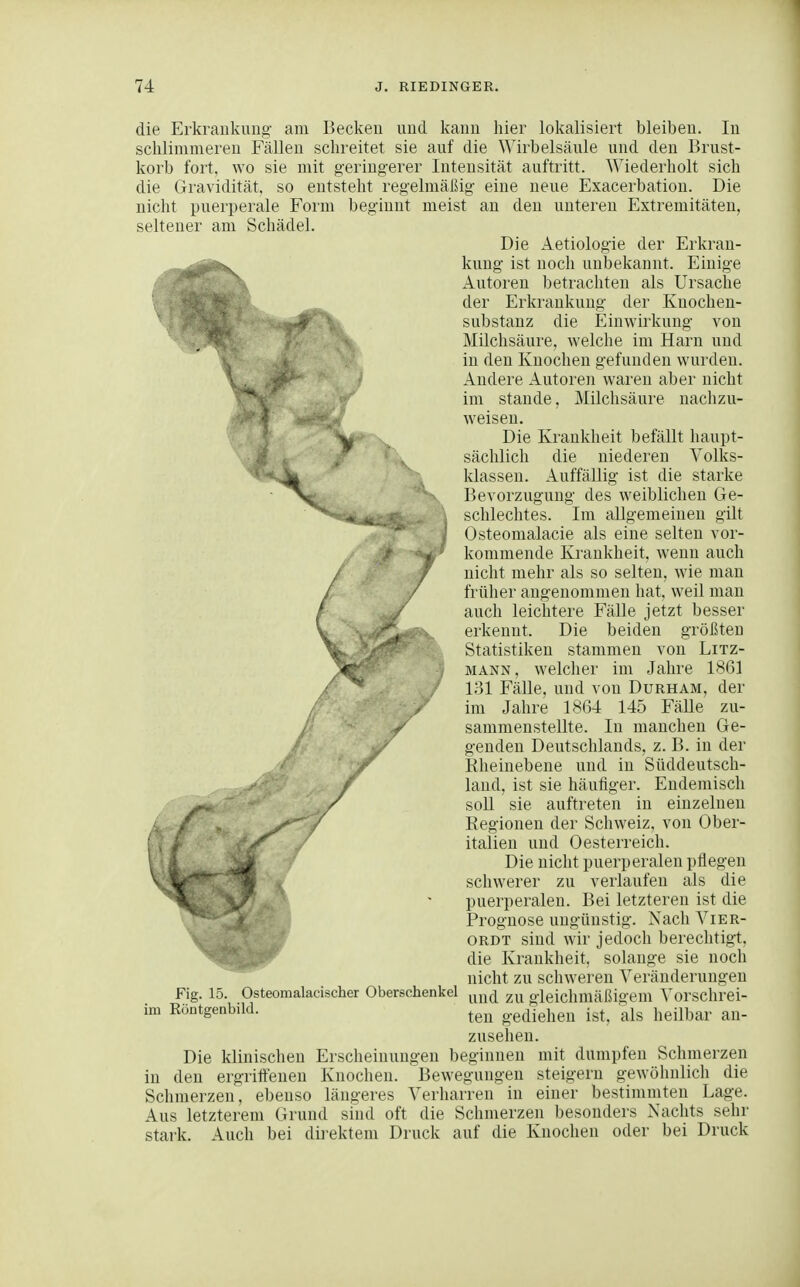 V / die Erkrankung am Becken und kann liier lokalisiert bleiben. In schlimmeren Fällen schreitet sie auf die Wirbelsäule und den Brust- korb fort, wo sie mit g-eringerer Intensität auftritt. Wiederholt sich die Gravidität, so entsteht regelmäßig eine neue Exacerbation. Die nicht puerperale Form beginnt meist an den unteren Extremitäten, seltener am Schädel. Die Aetiologie der Erkran- kung ist noch unbekannt. Einige Autoren betrachten als Ursache der Erkrankung der Knochen- substanz die Einwirkung von Milchsäure, welche im Harn und in den Knochen gefunden wurden. Andere Autoren waren aber nicht im stände, Milchsäure nachzu- weisen. Die Krankheit befällt haupt- sächlich die niederen Volks- klassen. Auffällig ist die starke Bevorzugung des weiblichen Ge- schlechtes. Im allgemeinen gilt Osteomalacie als eine selten vor- kommende Krankheit, wenn auch nicht mehr als so selten, wie man früher angenommen hat, weil man auch leichtere Fälle jetzt besser erkennt. Die beiden größten Statistiken stammen von Litz- mann, welcher im Jahre 1861 lol Fälle, und von Durham, der im Jahre 1864 145 Fälle zu- sammenstellte. In manchen Ge- genden Deutschlands, z. B. in der Kheinebene und in Süddeutsch- land, ist sie häufiger. Endemisch soU sie auftreten in einzelnen Regionen der Schweiz, von Ober- italien und Oesterreich. Die nicht puerperalen pflegen schwerer zu verlaufen als die puerperalen. Bei letzteren ist die Prognose ungünstig. Nach Vier- ordt sind wir jedoch berechtigt, die Krankheit, solange sie noch nicht zu schweren Veränderungen und zu gleichmäßigem Vorschrei- ten gediehen ist, als heilbar an- zusehen. Die klinischen Erscheinungen beginnen mit dumpfen Schmerzen in den ergriffenen Knochen. Bewegungen steigern gewöhnlich die Schmerzen, ebenso längeres Verliarren in einer bestimmten Lage. Aus letzterem Grund sind oft die Schmerzen besonders Nachts sehr stark. Auch bei direktem Druck auf die Knochen oder bei Druck Fig. 15. Osteomalacischer Oberschenkel im Röntgenbild.