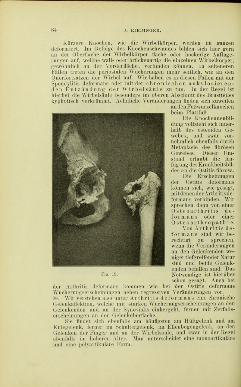 Kürzere Knochen, wie die \Mrbelkörper, werden im ganzen deformiert. Im (iefolg-e des Knochenscliwundes bilden sich hier g-eru au der Obei'Üäche der ^Mrbellvüri)er flache oder höckerig-e Auflag-e- rungen auf, welche wall- oder brückenartig die einzelnen A\'irbelkörper, g'ewölinlicli au der Vorderfläche, verbinden können. In seltenereu Fällen treten die periostalen ^^'ucherungen mehr seitlich, wie an deu Querfortsätzen der AMrbel auf. AMr liaben es in diesen Fällen mit der Spondylitis deformans oder mit der chronischen ankylosieren- den Eni Zündung der ^^'irbelsäule zu tun. In der Reg:el ist hierbei die ^^irbelsäule besonders im oberen Abschnitt des Brustteiles kj^photisch verkrümmt. Aehnliche Veränderungen flnden sich zuweilen au den Fußwurzelkuocheu beim Plattfuß. Die Knochenneubil- dung vollzieht sich inner- halb des osteoiden Ge- webes, und zwar vor- nehmlich ebenfalls durch Metaplasie des fibrösen Gewebes. Dieser Um- stand erlaubt die An- fügung des Krankheitsbil- des an die Ostitis übrosa. Die Erscheinungen der Ostitis deformans können sich, wie gesagt, mit denen der Arthritis de- formans verbinden. Wir sprechen dann von einer Osteoarthritis d e - f 0 r m ans oder einer Osteoarthropathie. Von Arthritis de- formans sind wir be- rechtigt zu sprechen, wenn die Veränderungen an den Gelenkenden we- niger tiefgreifender Natur sind und beide Gelenk- euden befallen sind. Das Notwendige ist hierüber schon gesagt. Auch bei der Arthritis deformans kommen wie bei der Ostitis deformans Wucherungsersclieinungen neben regressiven Veränderungen vor. Wir verstehen also unter Arthritis deformans eine chronische Gelenkaltektion. welche mit starken \\'uclierungserscheinungen an den Gelenkenden und an der Synovialis einliergeht, ferner mit ZerfaUs- ersclieinungen an der Gelenkoberfläclie. Sie findet sich ebenfalls am häufigsten am Hüftgelenk und am Kniegelenk, ferner im Schultergelenk, im Ellenbogengelenk, an den (jelenken der Finger und an der ^^■irbelsäule, und zwar in der Kegel ebenfalls im höheren Alter. Man unterscheidet eine monoartikuläre und eine polyartikuläre Form.