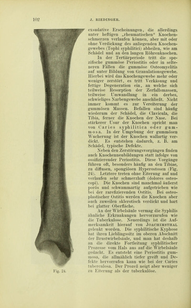 exsudative Erscheinungen, die allerdings, unter heftigen „rheumatischen Kuochen- schmerzen verlaufen können, aber mit oder ohne Verdickung des anliegenden Knochen- gewebes (Tophi sj'philitici) abheilen, wie am Schädel und an den langen Röhrenknochen. In der Tertiärperiode tritt die spe- zifische gummöse Periostitis oder in selte- neren Fällen die gummöse Osteomyelitis auf unter Bildung von Granulationsgewebe. Hierbei wird das Knochengewebe mehr oder weniger zerstört, es tritt Verkäsung und fettige Degeneration ein, an welche sich teilweise Resorption der Zerfallsmassen, teilweise Umwandlung in ein derbes, schwieliges Narbengewebe anschließt. Nicht immer kommt es zur Vereiterung der gummösen Massen. Befallen sind häufig wiederum der Schädel, die Clavicula, die Tibia, ferner die Knochen der Nase. Bei stärkerer Usur der Knochen spricht man von Caries syphilitica oder gum- mosa. In der Umgebung der gummösen A^^ucherung ist der Knochen wallartig ver- dickt. Es entstehen dadurch, z. B. am Schädel, typische Defekte. Neben den Zerstörungsvorgängen finden auch Kuochenneubilduugen statt infolge von ossifizierender Periostitis. Diese Vorgänge führen oft, besonders häufig an den Tibiae, zu diftusen, spongiösen H}'perostosen (Fig. 24). Letztere treten ohne Eiterung auf und verlaufen sehr schmerzhaft (dolores osteo- copi). Die Knochen sind manchmal äußerst porös uud schwammartig aufgetrieben wie bei der rarefizierenden Ostitis. Bei osteo- plastischer Ostitis werden die Knochen aber auch zuweilen sklerotisch verdickt und hart bei glatter Oberfläche. An der Wirbelsäule vermag die Sy philis ähnliche Erkrankungen hervorzurufen wie die Tuberkulose. Neuerdings ist die Auf- merksamkeit hierauf von Joachimsthal gelenkt worden. Die syphilitische Kyphose hat ihren Lieblingssitz im oberen Abschnitt der Brustwirbelsäule, und man hat deshalb an die direkte Fortleitung sji^hilitischer Prozesse vom Hals aus auf die AMrbelsäule gedacht. Es entsteht eine Periostitis gum- mosa, die allmählich tiefer greift und De- fekte hervorrufen kann wie bei der Caries tuberculosa. Der Prozeß neigt aber weniger zu p]iterung als der tuberkulöse.