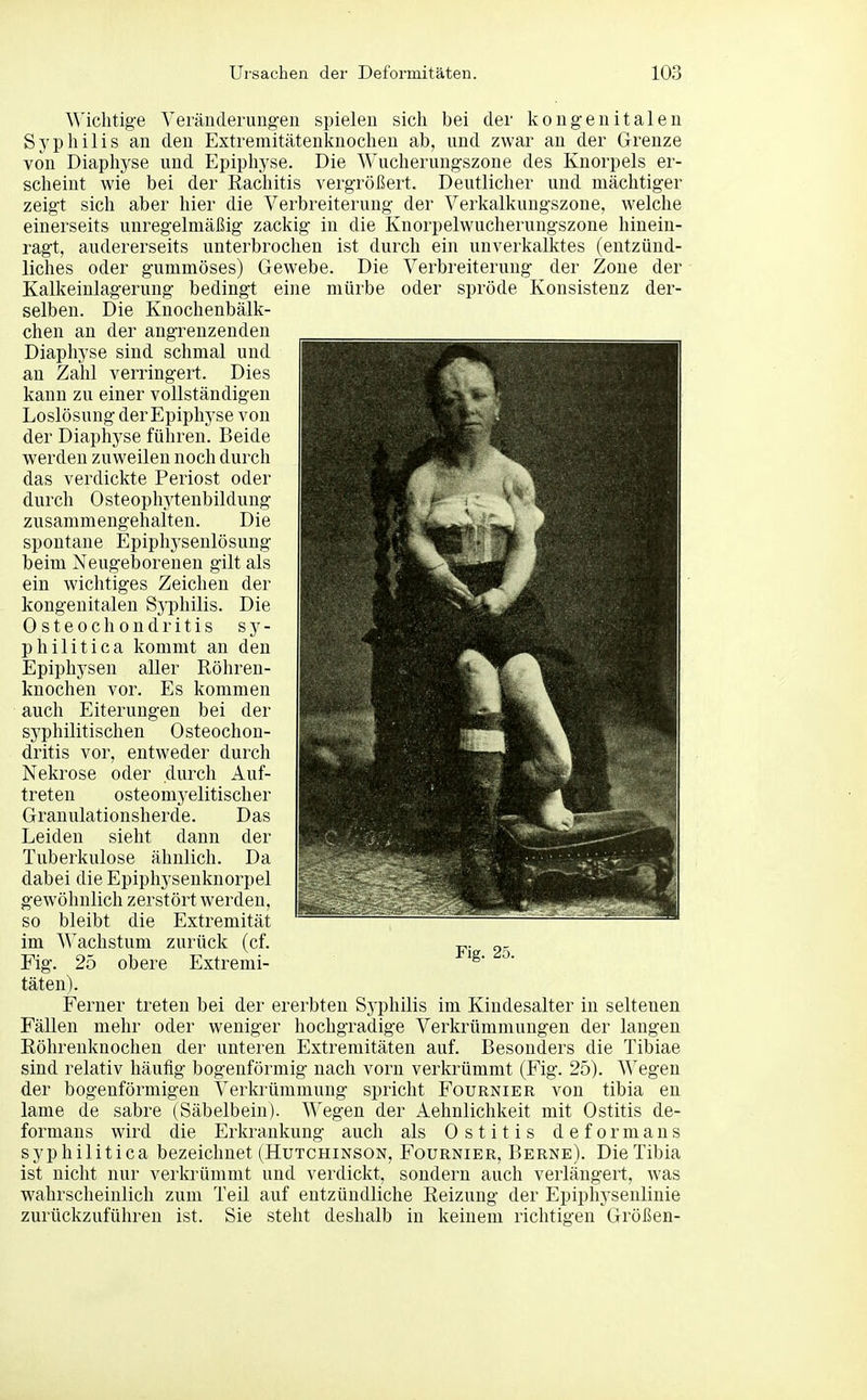 Wichtige Veränderungen spielen sich bei der kongenitalen Sj^philis an den Extremitätenknochen ab, und zwar an der Grenze von Diaphyse und Epiphyse. Die Wucherungszone des Knorpels er- scheint wie bei der Rachitis vergröISert. Deutlicher und mächtiger zeigt sich aber hier die Verbreiterung der Verkalkungszone, welche einerseits unregelmäßig zackig in die Knorpelwucherungszone hinein- ragt, andererseits unterbrochen ist durch ein unverkalktes (entzünd- liches oder gummöses) Gewebe. Die Verbreiterung der Zone der Kalkeinlagerung bedingt eine mürbe oder spröde Konsistenz der- selben. Die Knochenbälk- chen an der angrenzenden Diaphyse sind schmal und an Zahl verringert. Dies kann zu einer vollständigen Loslösung der Epiphyse von der Diaphyse führen. Beide werden zuweilen noch durch das verdickte Periost oder durch Osteophytenbildung zusammengehalten. Die spontane Epiphysenlösung beim Neugeborenen gilt als ein wichtiges Zeichen der kongenitalen Syphilis. Die Osteochondritis sy- philitica kommt an den Epiphysen aller Röhren- knochen vor. Es kommen auch Eiterungen bei der syphilitischen Osteochon- dritis vor, entweder durch Nekrose oder durch Auf- treten osteomyelitischer Granulationsherde. Das Leiden sieht dann der Tuberkulose ähnlich. Da dabei die Epiphyseuknorpel gewöhnlich zerstört werden, so bleibt die Extremität im Wachstum zurück (cf. Fig. 25 obere Extremi- täten). Ferner treten bei der ererbten Sj-philis im Kindesalter in seltenen Fällen mehr oder weniger hochgradige Verkrümmungen der langen Röhrenknochen der unteren Extremitäten auf. Besonders die Tibiae sind relativ häufig bogenförmig nach vorn verkrümmt (Fig. 25). Wegen der bogenförmigen Verkrümmung spricht Fournier von tibia en lame de sabre (Säbelbein). Wegen der Aehnlichkeit mit Ostitis de- formans wird die Erkrankung auch als Ostitis d e f o r m a n s syphilitica bezeichnet (Hutchinson, Fournier, Berne). Die Tibia ist nicht nur verkrümmt und verdickt, sondern auch verlängert, was wahrscheinlich zum Teil auf entzündliche Reizung der Epiphysenlinie zurückzuführen ist. Sie steht deshalb in keinem richtigen Größen-