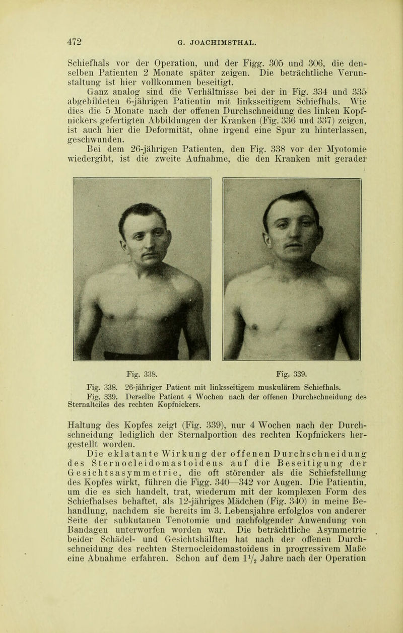 Schiefhals vor der Operation, und der Figg. 305 und 306, die den- selben Patienten 2 Monate später zeigen. Die beträchtliche Verun- staltung ist hier vollkommen beseitigt. Ganz analog sind die Verhältnisse bei der in Fig. 334 und 335 abgebildeten 6-jährigen Patientin mit linksseitigem Schiefhals. Wie dies die 5 Monate nach der oftenen Durchschneiclung des linken Kopf- nickers gefertigten Abbildungen der Kranken (Fig. 336 und 337) zeigen, ist auch hier die Deformität, ohne irgend eine Spur zu hinterlassen, geschwunden. Bei dem 26-jährigen Patienten, den Fig. 338 vor der Myotomie wiedergibt, ist die zweite Aufnahme, die den Kranken mit gerader Fig. 338. Fig. 339. Fig. 338. 26-jähriger Patient mit linksseitigem muskulärem Schiefhals. Fig. 339. Derselbe Patient 4 Wochen nach der offenen Durchschneidung des Sternalteiles des rechten Kopfnickers. Haltung des Kopfes zeigt (Fig. 339), nur 4 Wochen nach der Durch- schneidung lediglich der Sternalportion des rechten Kopfnickers her- gestellt worden. Die eklatante Wirkung der offenen Durchschneidung des Sternocleidomastoideus auf die Beseitigung der Gesichtsasymmetrie, die oft störender als die Schiefstellung des Kopfes wirkt, führen die Figg. 340—342 vor Augen. Die Patientin, um die es sich handelt, trat, wiederum mit der komplexen Form des Schieflialses behaftet, als 12-jähriges Mädchen (Fig. 340) in meine Be- handlung, nachdem sie bereits im 3. Lebensjahre erfolglos von anderer Seite der subkutanen Tenotomie und nachfolgender Anwendung von Bandagen unterworfen worden war. Die beträchtliche Asymmetrie beider Schädel- und Gesichtsliälften hat nach der offenen Durch- schneidung des rechten Sternocleidomastoideus in progressivem Maße eine Abnahme erfahren. Schon auf dem IY2 Jahre nach der Operation