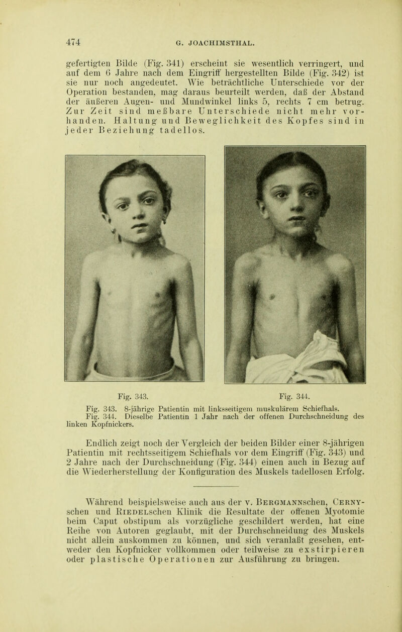 gefertigten Bilde (Fig. 341) erscheint sie wesentlich verringert, und auf dem 6 Jahre nach dem Eingriff' hergestellten Bilde (Fig. 342) ist sie nur noch angedeutet. Wie beträchtliche Unterschiede vor der Operation bestanden, mag daraus beurteilt werden, daß der Abstand der äußeren Augen- und Mundwinkel links 5, rechts 7 cm betrug. Zur Zeit sind meßbare Unterschiede nicht mehr vor- handen. Haltung und Beweglichkeit des Kopfes sind in jeder Beziehung tadellos. Endlich zeigt noch der Vergleich der beiden Bilder einer 8-jährigen Patientin mit rechtsseitigem Schieflials vor dem Eingriff (Fig. 343) und 2 Jahre nach der Durchschnerdung (Fig. 344) einen auch in Bezug auf die Wiederherstellung der Konfiguration des Muskels tadellosen Erfolg. Während beispielsweise auch aus der v. BERGMANNschen, Cerny- schen und RiEDELschen Klinik die Resultate der offenen Myotomie beim Caput obstipum als vorzügliche geschildert werden, hat eine Reihe von Autoren geglaubt, mit der Durchschneidung des Muskels nicht allein auskommen zu können, und sich veranlaßt gesehen, ent- weder den Kopfnicker vollkommen oder teilweise zu exstirpieren oder plastische Operationen zur Ausführung zu bringen.