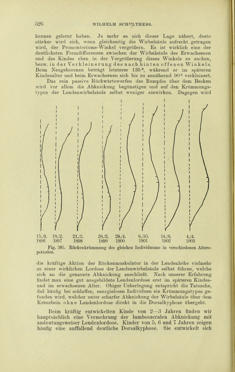 kennen gelernt haben. Je mehr es sich dieser Lage nähert, desto stärker wird sich, wenn gleichzeitig die Wirbelsäule aufrecht getragen wird, der Promontoriums-Winkel vergrößern. Es ist wirklich eine der deutlichsten Formdilferenzen zwischen der Wirbelsäule des Erwachsenen und des Kindes eben in der ^Vergrößerung dieses Winkels zu suchen, bezw. in der Verkleinerung des nach hinten offenen Winkels. Beim Neugeborenen beträgt letzterer 135während er im späteren Kindesalter und beim Erwachsenen sich bis zu annähernd 90 verkleinert. Das rein passive Rückwärtswerfen des Rumpfes über dem Becken wird vor allem die Abknickung begünstigen und auf den Krümmungs- tj'pus der Lendenwirbelsäule selbst weniger einwirken. Dagegen wird 15./9. 1S./2. 21./2. 28./2. 28./4. 8./10. 14./8. 4./4, 1896 1897 1898 1899 1900 1901 1902 1903 Fig. 385. Rückenkrümmung des gleichen Individuums in verschiedenen Alters- perioden. die kräftige Aktion der Rückenmuskulatur in der Lendenhöhe vielmehr zu einer wirklichen Lordose der Lendenwirbelsäule selbst führen, welche sich an die genannte Abknickung anschließt. Nach unserer Erfahrung findet man eine gut ausgebildete Lendenlordose erst im späteren Kindes- und im erwachsenen Alter. Obiger Ueberlegung entspricht die Tatsache, daß häufig bei schlaffen, energielosen Individuen ein Krümmungstypus ge- funden wird, welcher unter scharfer Abknickung der Wirbelsäule über dem Kreuzbein ohne Lendenlordose direkt in die Dorsalkyjjhose übergeht. Beim kräftig entwickelten Kinde von 2—3 Jahren finden wir hauptsächlich eine Vermehrung der lumbosacraleu Abknickung- mit andeutungsweiser Lendenlordose. Kinder von 5, 6 und 7 Jahren zeigen häufig eine auffallend deutliche Dorsalkyphose. Sie entwickelt sich