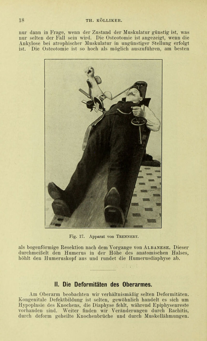 nur dann in Frage, wenn der Zustand der Muskulatur günstig ist, was nur selten der Fall sein wird. Die Osteotomie ist angezeigt, wenn die Ankylose bei atrophischer Muskulatur in ungünstiger Stellung erfolgt ist. Die Osteotomie ist so hoch als möglich auszuführen, am besten Fig. 17. Apparat von Trennert. als bogenförmige Resektion nach dem Vorgange von Albanese. Dieser durchmeißelt den Humerus in der Höhe des anatomischen Halses, höhlt den Humeruskopf aus und rundet die Humerusdiaphyse ab. II. Die Deformitäten des Oberarmes. Am Oberarm beobachten wir verhältnismäßig selten Deformitäten. Kongenitale Defektbildung ist selten, gewöhnlich handelt es sich um Hypoplasie des Knochens, die Diaphyse fehlt, während Epiphysenreste vorhanden sind. Weiter finden wir Veränderungen durch Rachitis, durch deform geheilte Knochenbrüche und durch Muskellähmungen.