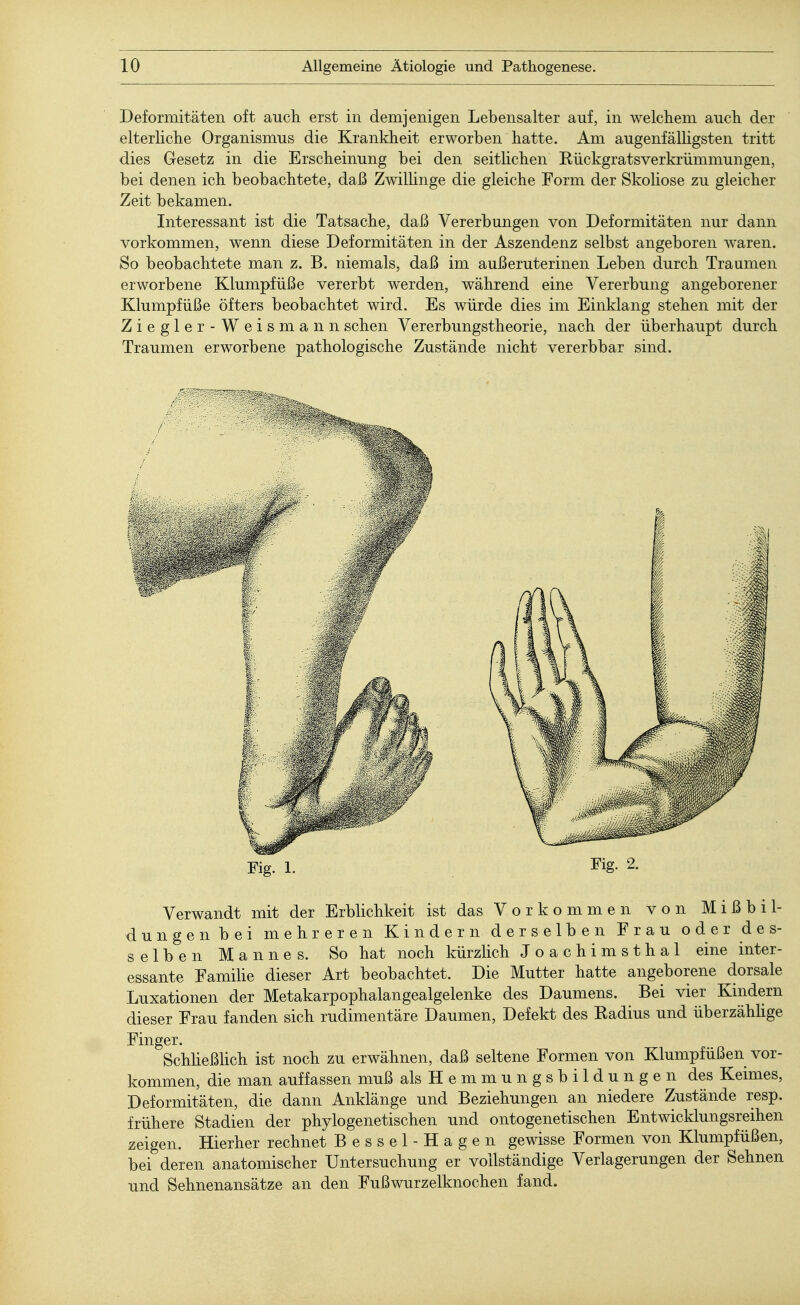 Deformitäten oft auch erst in demjenigen Lebensalter auf, in welchem auch der elterliche Organismus die Krankheit erworben hatte. Am augenfälligsten tritt dies Gesetz in die Erscheinung bei den seitlichen Eückgratsverkrümmungen, bei denen ich beobachtete, daß Zwillinge die gleiche Form der Skoliose zu gleicher Zeit bekamen. Interessant ist die Tatsache, daß Vererbungen von Deformitäten nur dann vorkommen, wenn diese Deformitäten in der Aszendenz selbst angeboren waren. So beobachtete man z. B. niemals, daß im außeruterinen Leben durch Traumen erworbene Klumpfüße vererbt werden, während eine Vererbung angeborener Klumpfüße öfters beobachtet wird. Es würde dies im Einklang stehen mit der Ziegler-Weismann sehen Vererbungstheorie, nach der überhaupt durch Traumen erworbene pathologische Zustände nicht vererbbar sind. Fig. 1. 2- Verwandt mit der Erblichkeit ist das Vorkommen von Mißbil- dungen bei mehreren Kindern derselben Frau oder des- selben Mannes. So hat noch kürzlich Joachimsthal eine inter- essante Familie dieser Art beobachtet. Die Mutter hatte angeborene dorsale Luxationen der Metakarpophalangealgelenke des Daumens. Bei vier Kindern dieser Frau fanden sich rudimentäre Daumen, Defekt des Badius und überzählige Finger. Schließlich ist noch zu erwähnen, daß seltene Formen von Klumpfußen vor- kommen, die man auffassen muß als Hemmungsbildungen des Keimes, Deformitäten, die dann Anklänge und Beziehungen an niedere Zustände resp. frühere Stadien der phylogenetischen und ontogenetischen Entwicklungsreihen zeigen. Hierher rechnet Bessel-Hagen gewisse Formen von Klumpfüßen, bei deren anatomischer Untersuchung er vollständige Verlagerungen der Sehnen und Sehnenansätze an den Fußwurzelknochen fand.