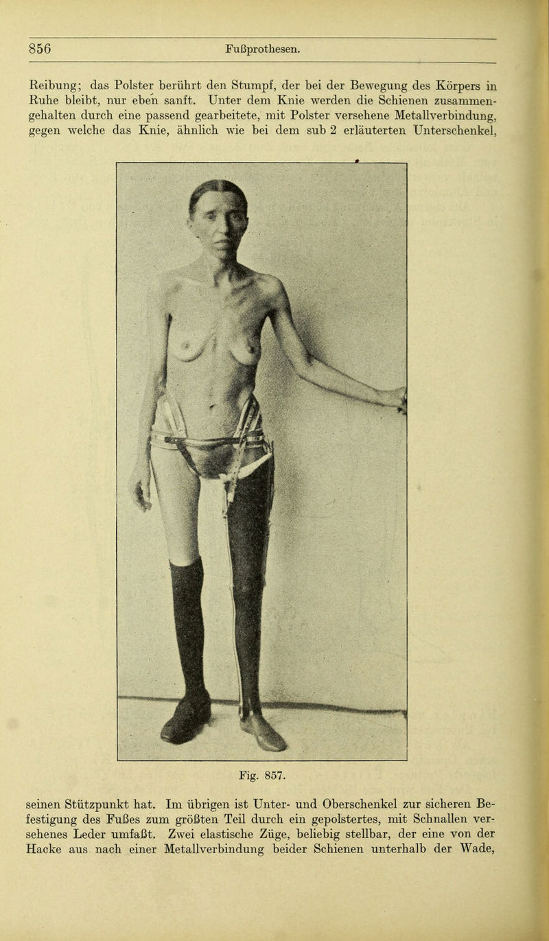 Reibung; das Polster berührt den Stumpf, der bei der Bewegung des Körpers in Ruhe bleibt, nur eben sanft. Unter dem Knie werden die Schienen zusammen- gehalten durch eine passend gearbeitete, mit Polster versehene Metallverbindung, gegen welche das Knie, ähnlich wie bei dem sub 2 erläuterten Unterschenkel, Fig. 857. seinen Stützpunkt hat. Im übrigen ist Unter- und Oberschenkel zur sicheren Be- festigung des Fußes zum größten Teil durch ein gepolstertes, mit Schnallen ver- sehenes Leder umfaßt. Zwei elastische Züge, beliebig stellbar, der eine von der Hacke aus nach einer Metallverbindung beider Schienen unterhalb der Wade,