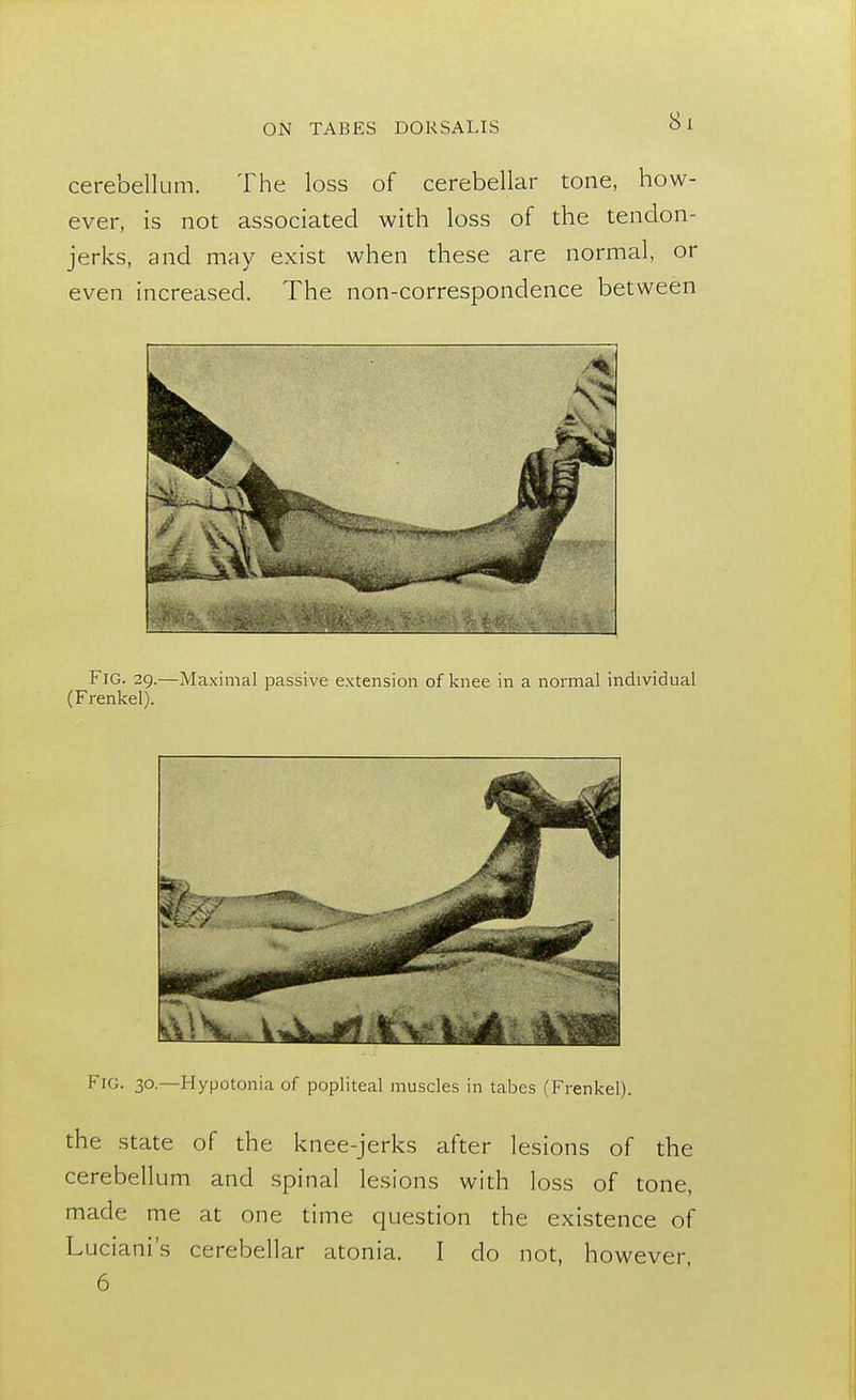 cerebellum. The loss of cerebellar tone, how- ever, is not associated with loss of the tendon- jerks, and may exist when these are normal, or even increased. The non-correspondence between FlG. 29.—Maximal passive extension of knee in a normal individual (Frenkel). Fig. 30.—Hypotonia of popliteal muscles in tabes (Frenkel). the state of the knee-jerks after lesions of the cerebellum and spinal lesions with loss of tone, made me at one time question the existence of Luciani's cerebellar atonia. I do not, however, 6