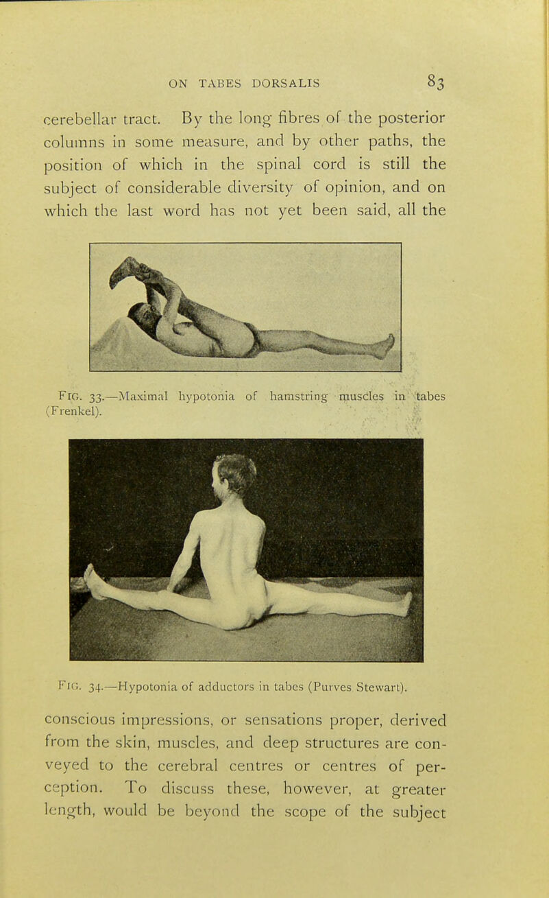 cerebellar tract. By the long fibres of the posterior columns in some measure, and by other paths, the position of which in the spinal cord is still the subject of considerable diversity of opinion, and on which the last word has not yet been said, all the FlG. 33.—Maximal hypotonia of hamstring muscles in tabes (Frenkel). Fig. 34.—Hypotonia of adductors in tabes (Purves Stewart). conscious impressions, or sensations proper, derived from the skin, muscles, and deep structures are con- veyed to the cerebral centres or centres of per- ception. To discuss these, however, at greater length, would be beyond the scope of the subject