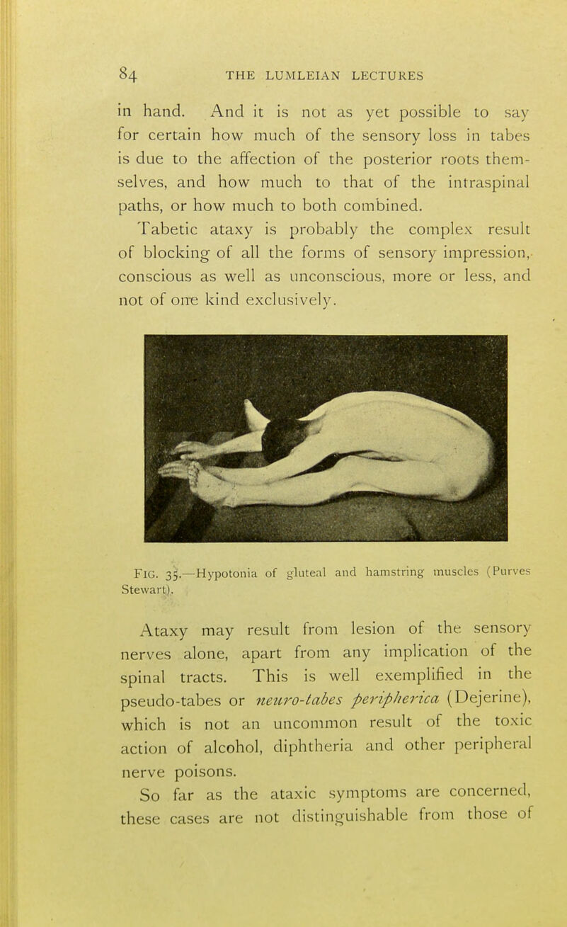 in hand. And it is not as yet possible to say for certain how much of the sensory loss in tabes is due to the affection of the posterior roots them- selves, and how much to that of the intraspinal paths, or how much to both combined. Tabetic ataxy is probably the complex result of blocking of all the forms of sensory impression,- conscious as well as unconscious, more or less, and not of one kind exclusively. ■ Fig. 35.—Hypotonia of gluteal and hamstring muscles (Purves Stewart). Ataxy may result from lesion of the sensory nerves alone, apart from any implication of the spinal tracts. This is well exemplified in the pseudo-tabes or neuro-tabes peripherica (Dejerine), which is not an uncommon result of the toxic action of alcohol, diphtheria and other peripheral nerve poisons. So far as the ataxic symptoms are concerned, these cases are not distinguishable from those of